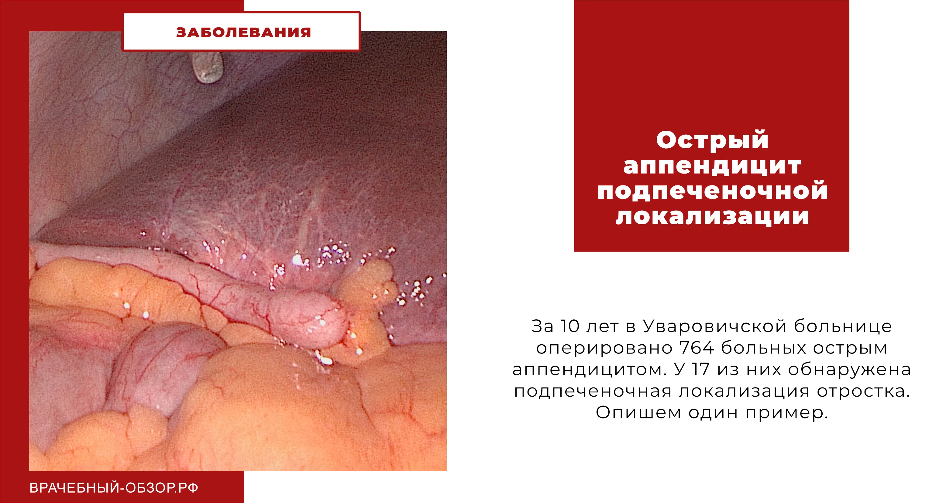 Острый аппендицит подпеченочной локализации