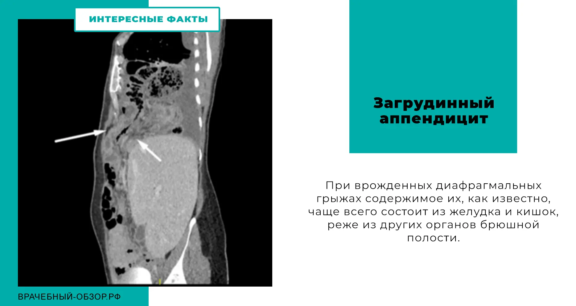 Загрудинный аппендицит