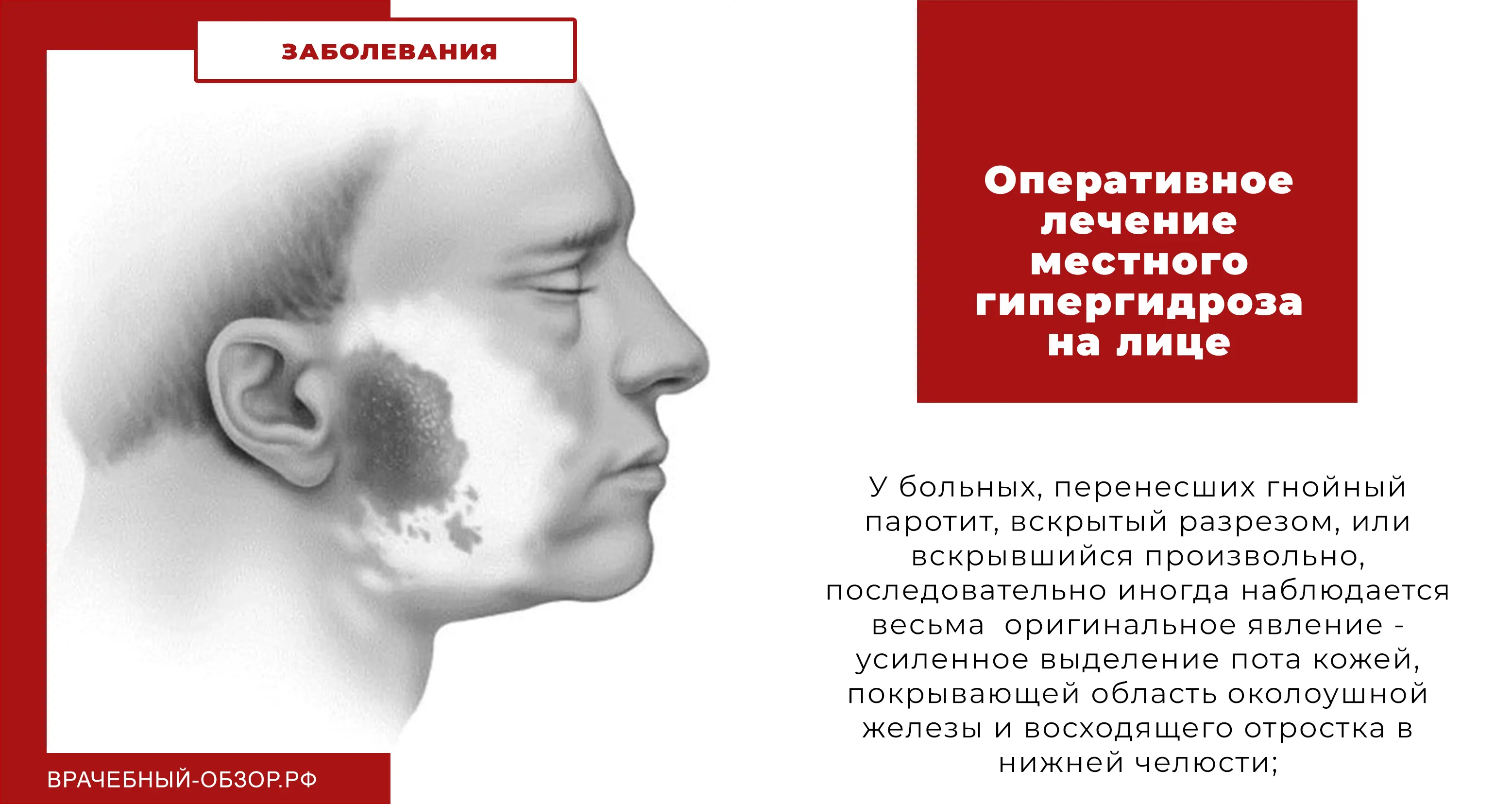 Оперативное лечение местного гипергидроза на лице
