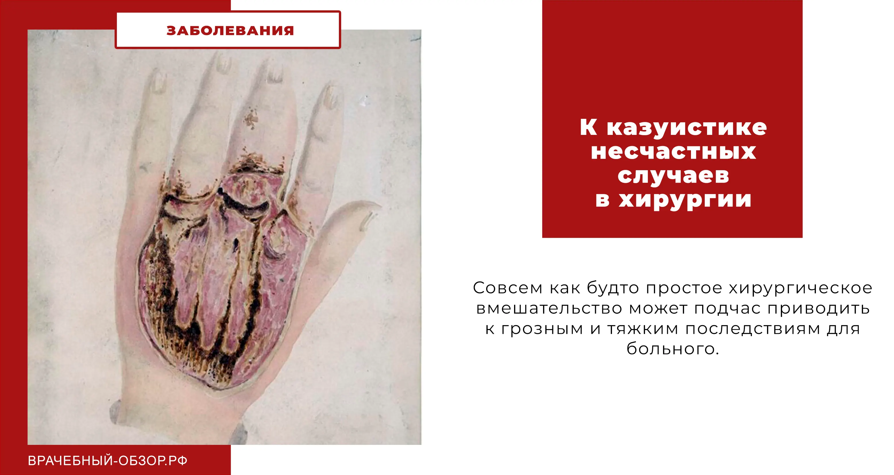 К казуистике несчастных случаев в хирургии