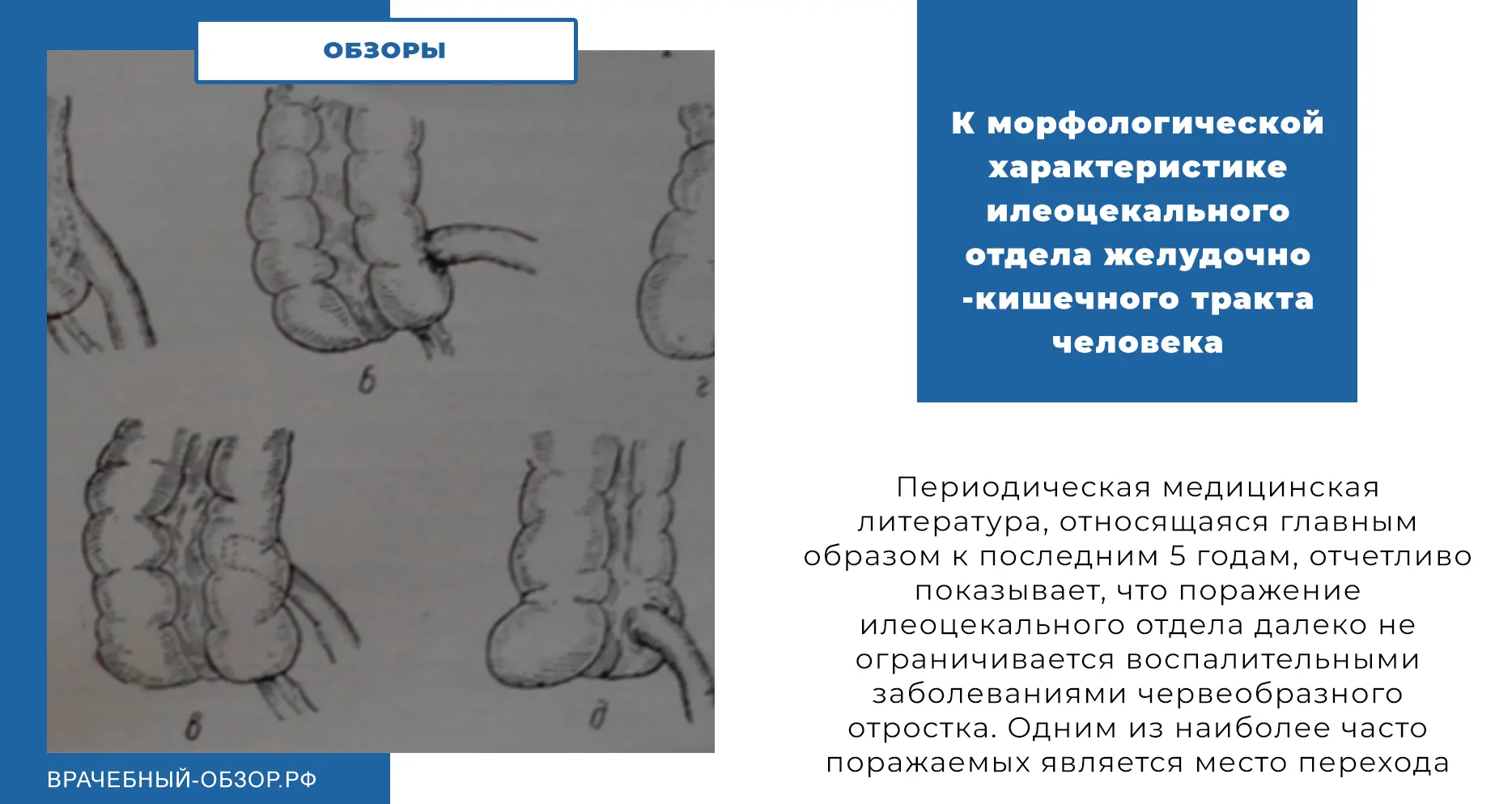 К морфологической характеристике илеоцекального отдела желудочно-кишечного тракта человека