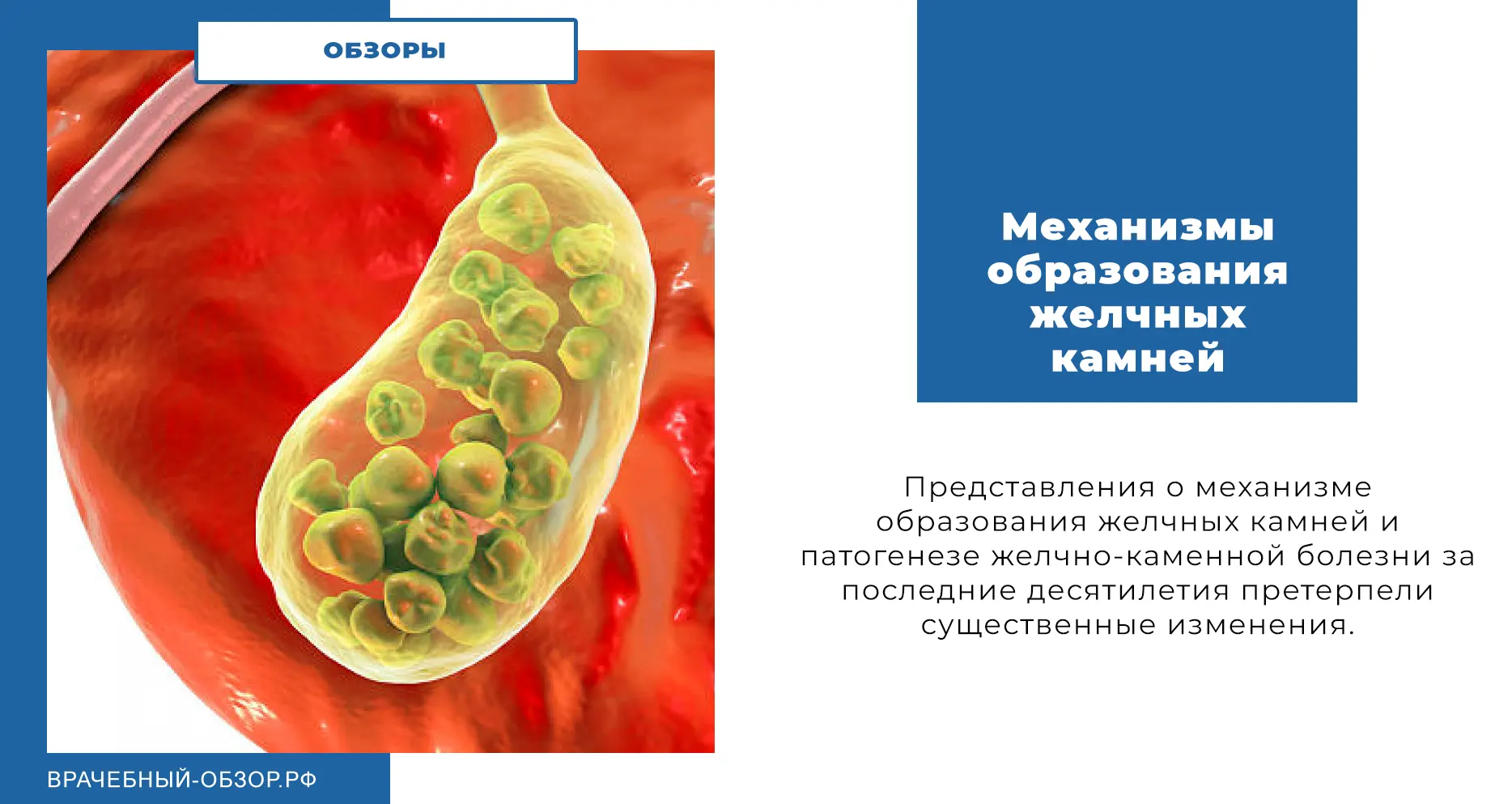 Механизмы образования желчных камней