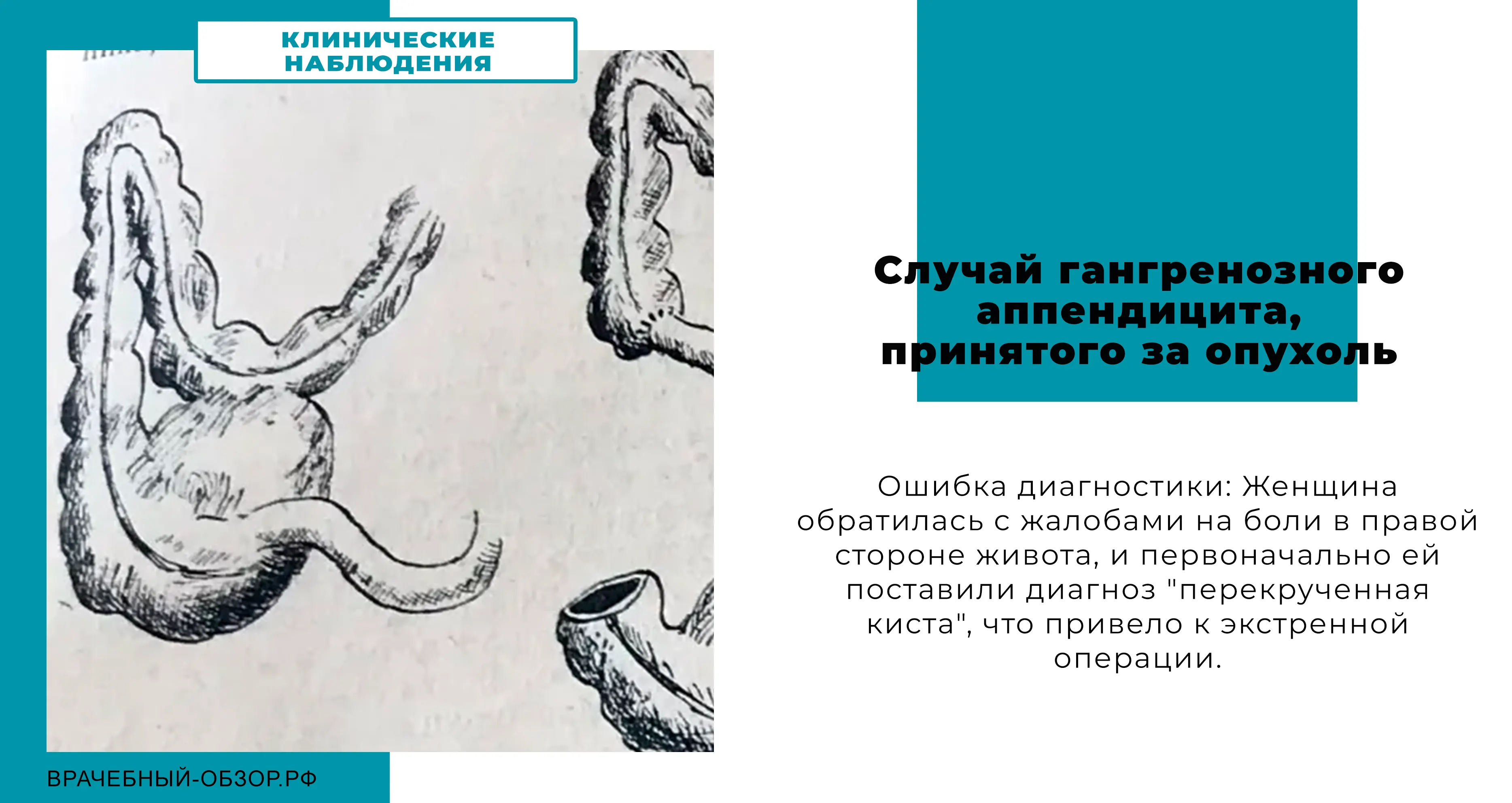 Случай гангренозного аппендицита, принятого за опухоль