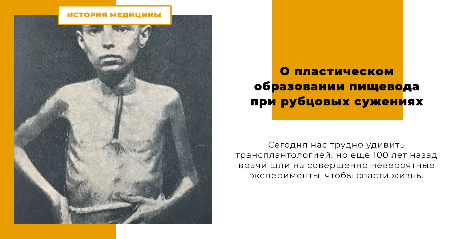 О пластическом образовании пищевода при рубцовых сужениях