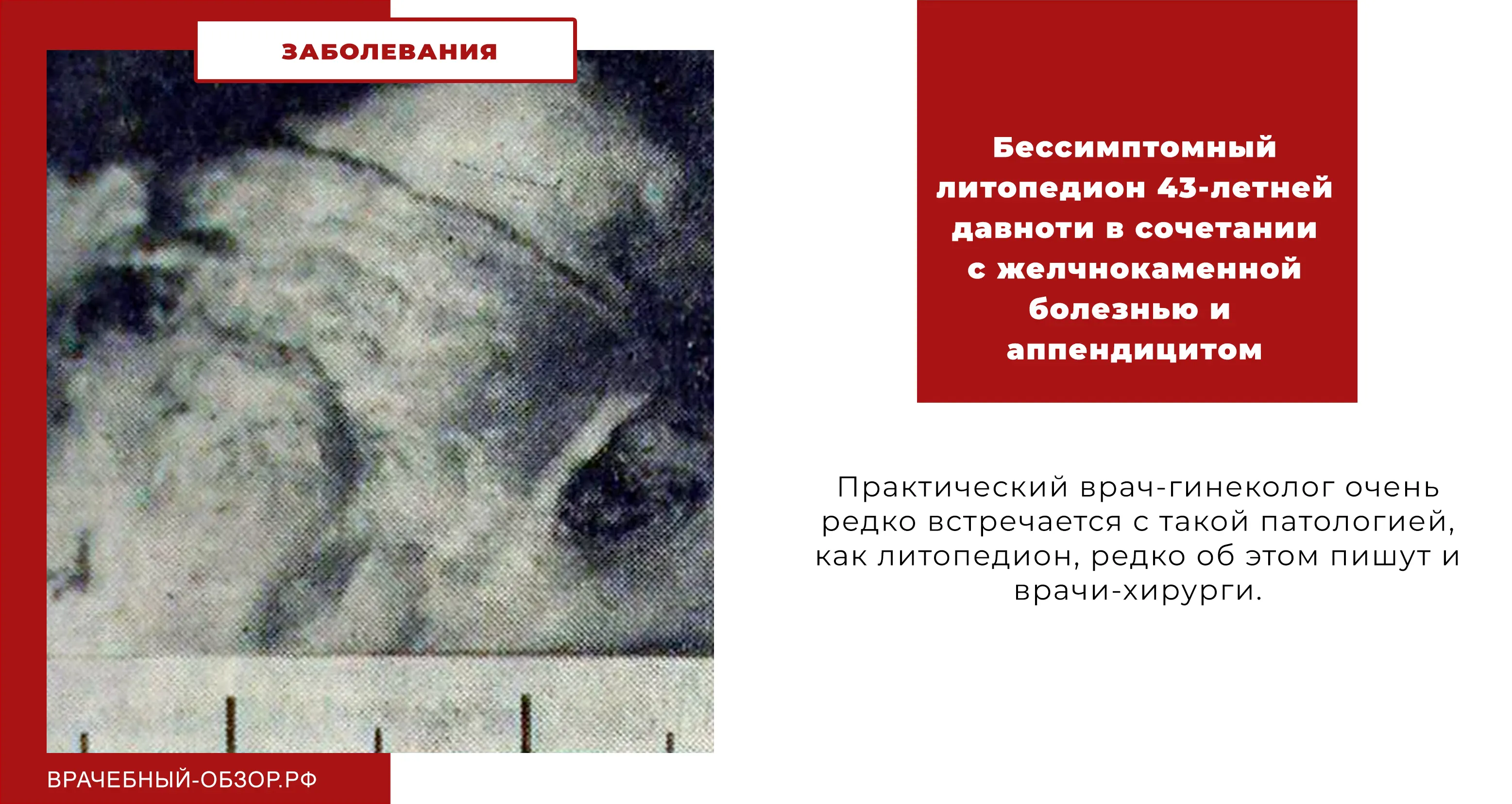 Бессимптомный литопедион 43-летней давноти в сочетании с желчнокаменной болезнью и аппендицитом
