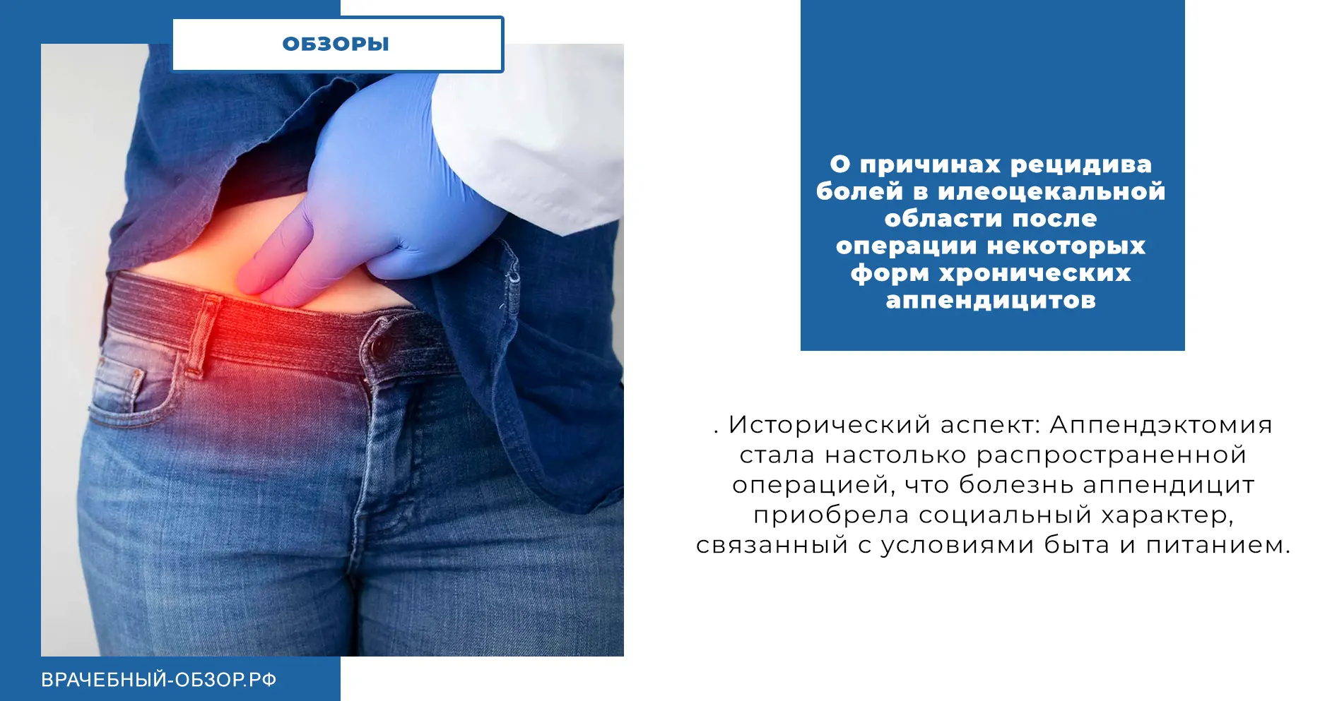 О причинах рецидива болей в илеоцекальной области после операции некоторых форм хронических аппендицитов
