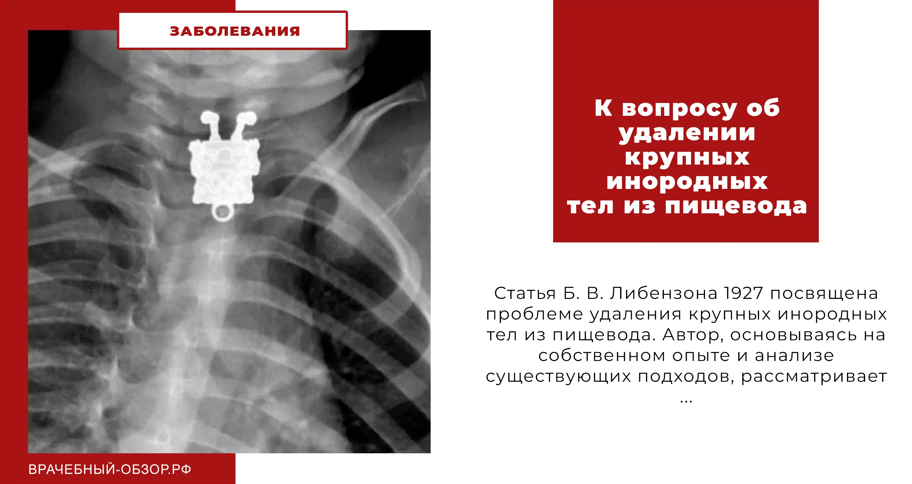 К вопросу об удалении крупных инородных тел из пищевода