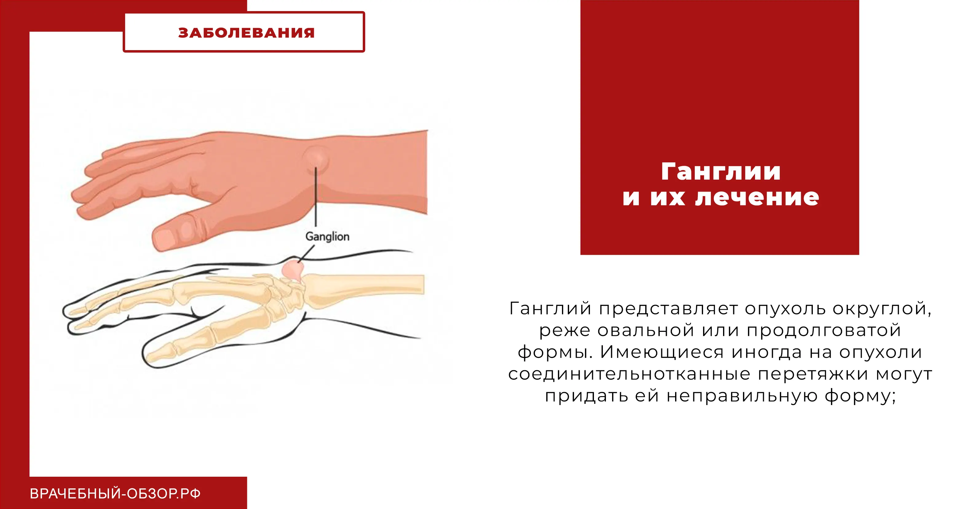 Ганглии и их лечение