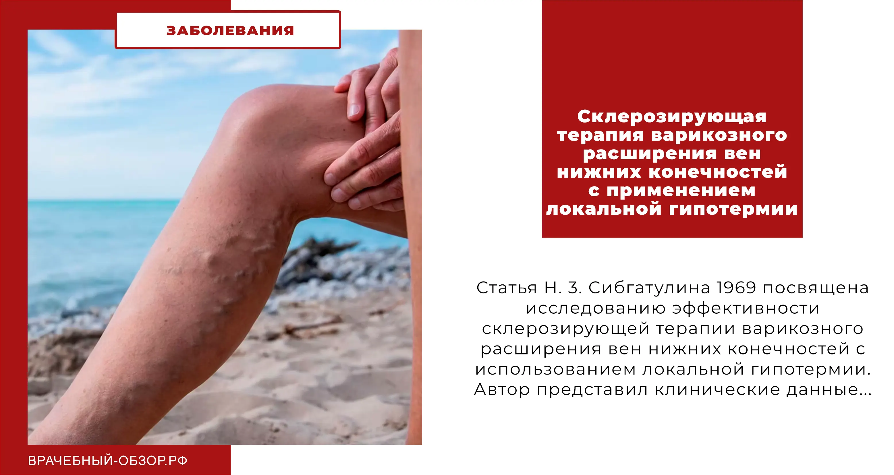 Склерозирующая терапия варикозного расширения вен нижних конечностей с применением локальной гипотермии