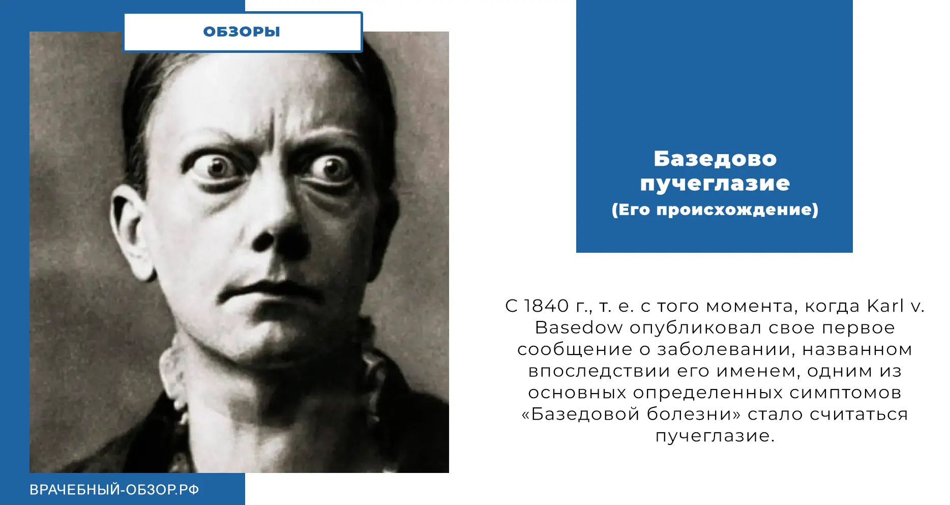 Базедово пучеглазие