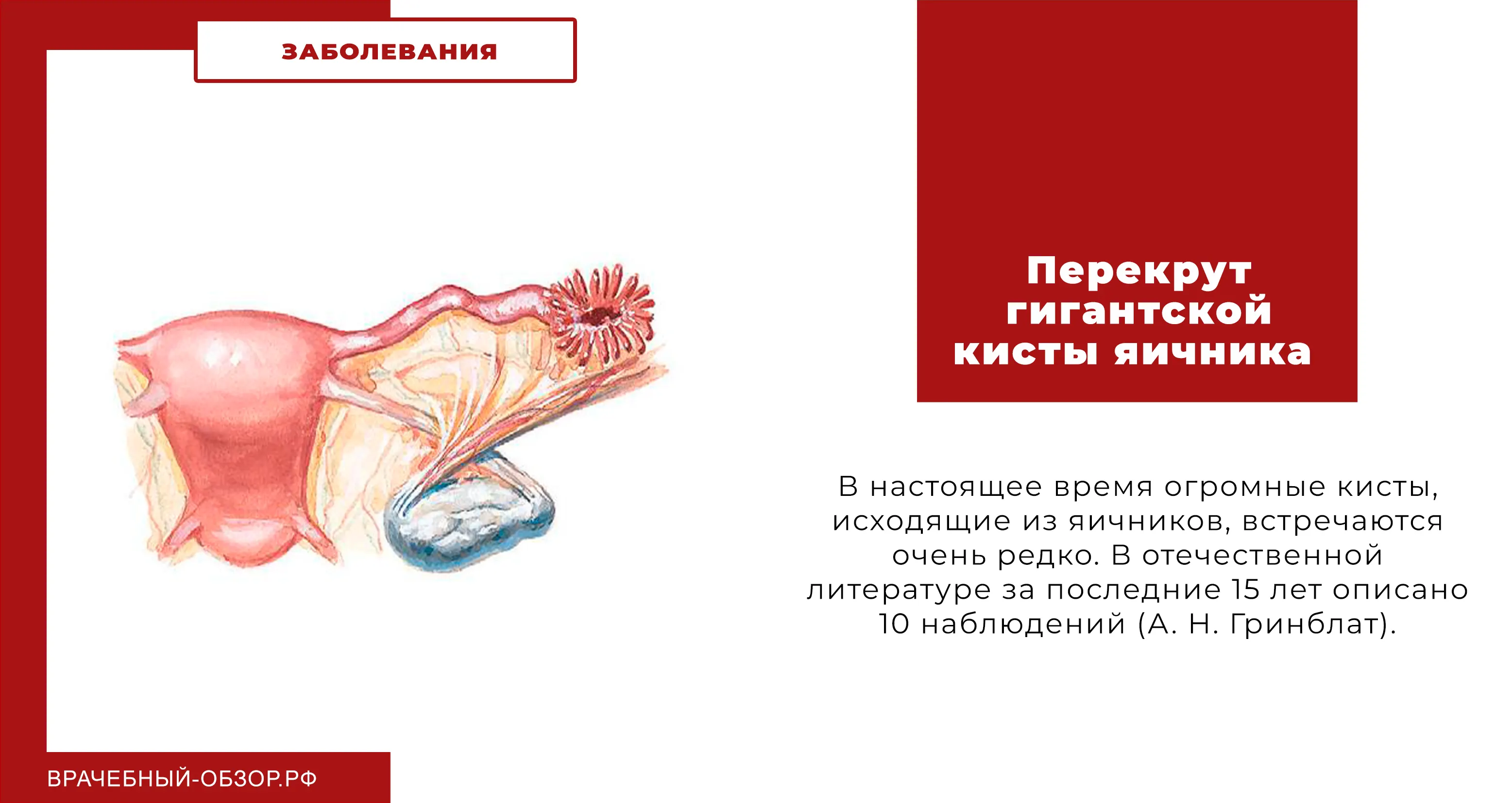 Перекрут гигантской кисты яичника