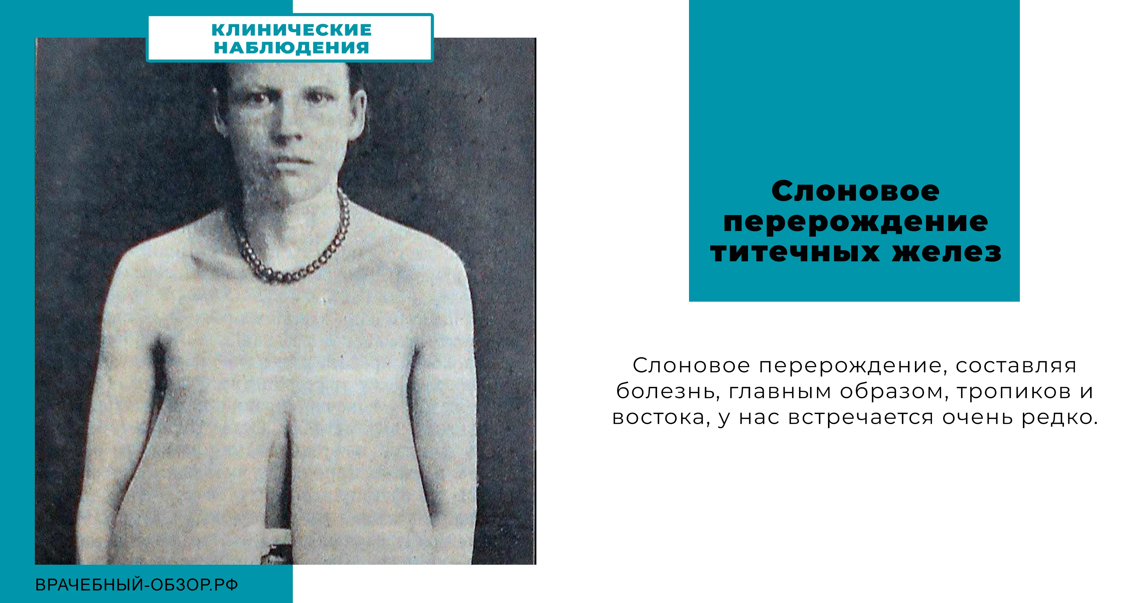 Слоновое перерождение титечных желез