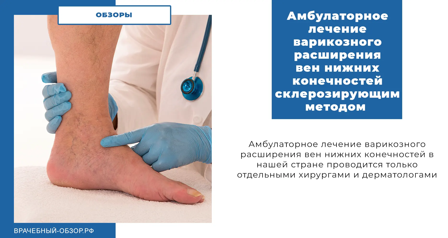 Амбулаторное лечение варикозного расширения вен нижних конечностей склерозирующим методом