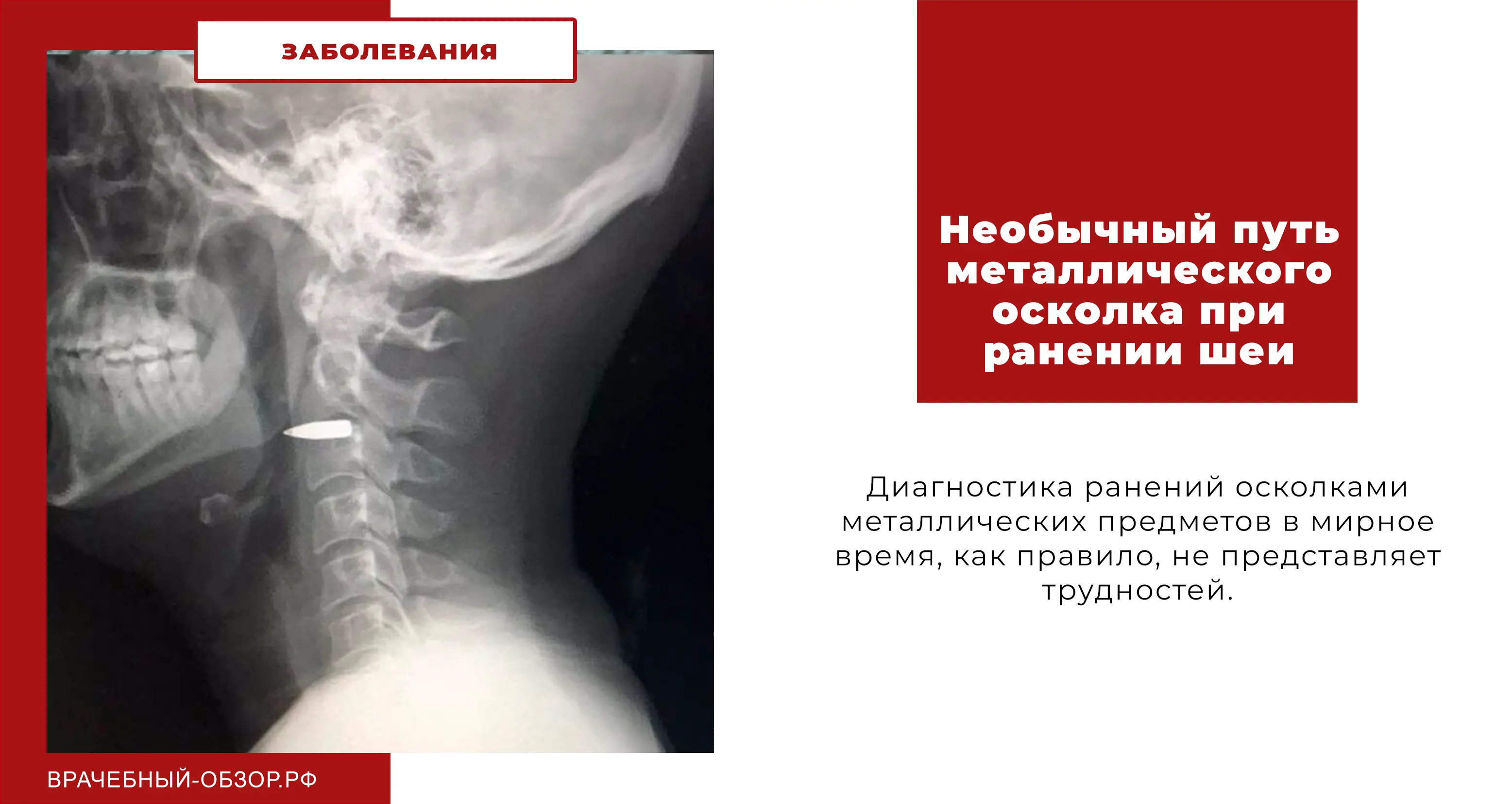 Необычный путь металлического осколка при ранении шеи