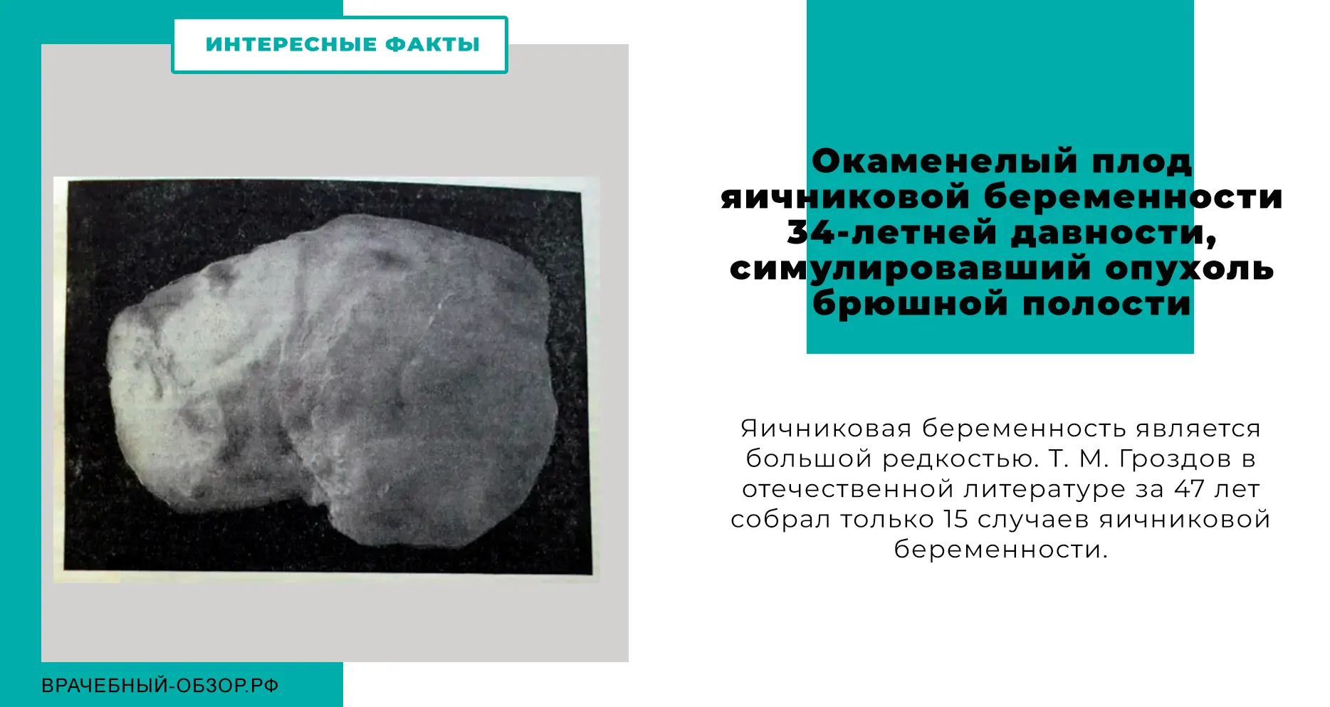 Окаменелый плод яичниковой беременности 34-летней давности, симулировавший опухоль брюшной полости