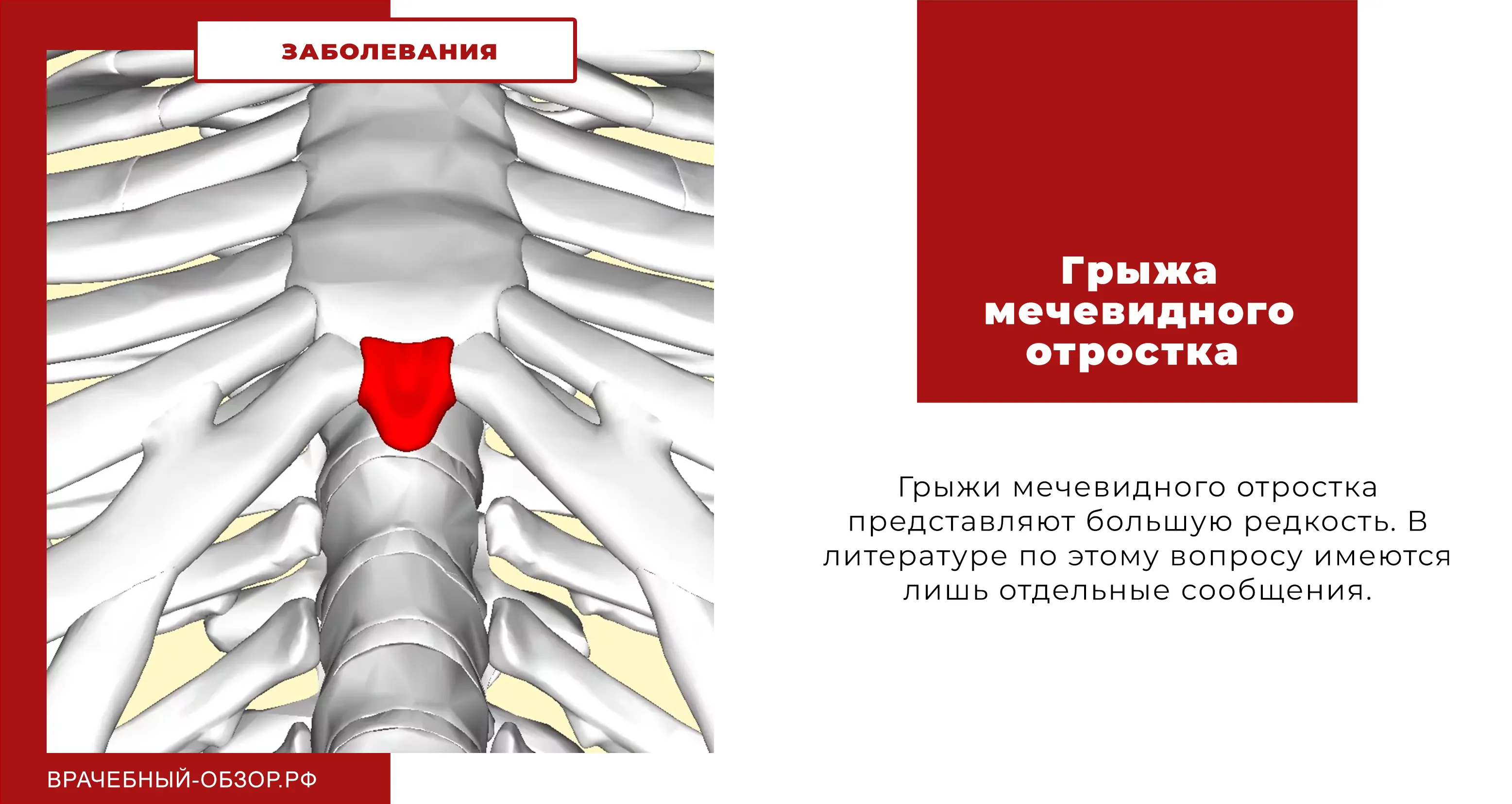 Грыжа мечевидного отростка