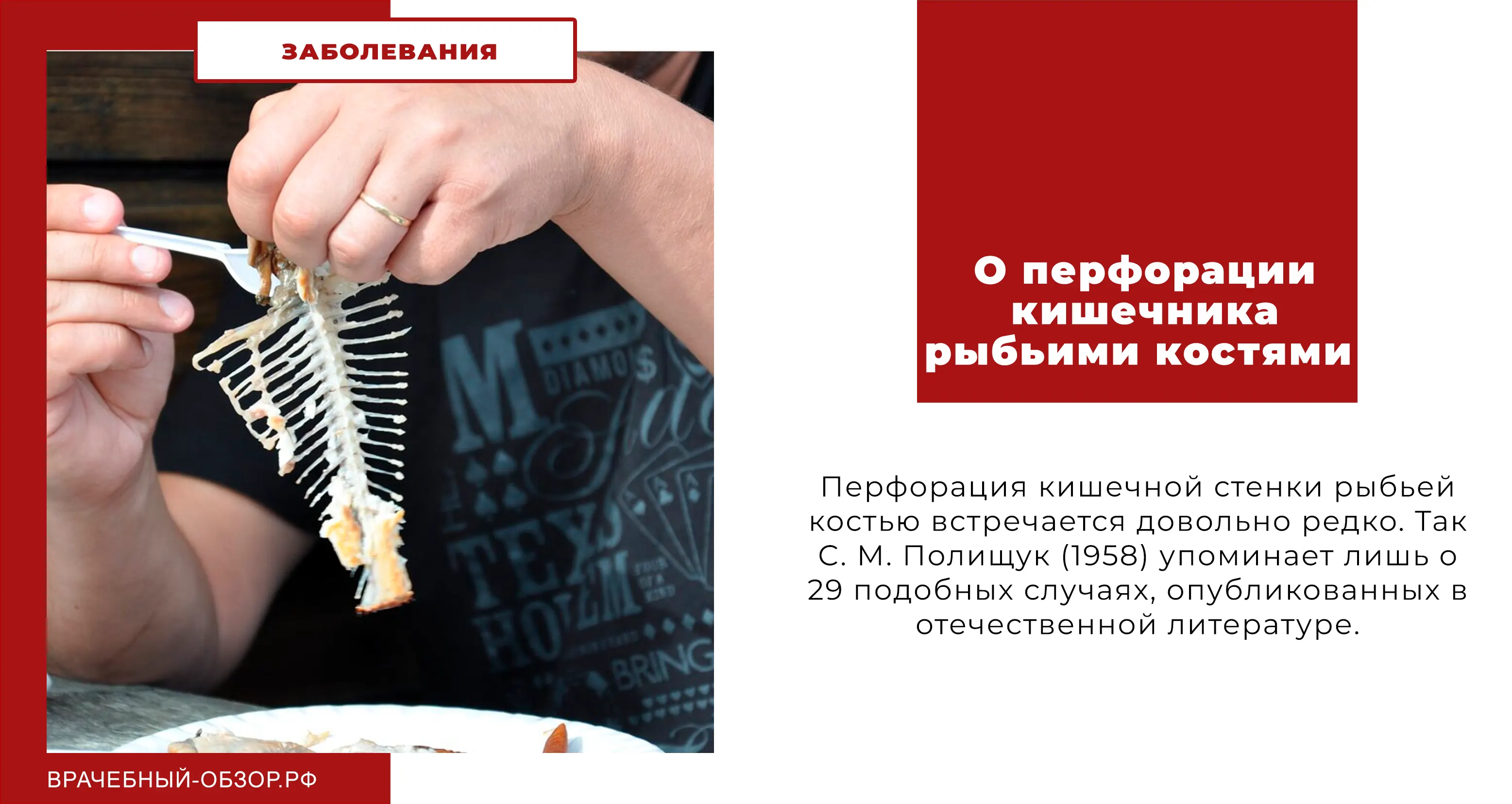 О перфорации кишечника рыбьими костями