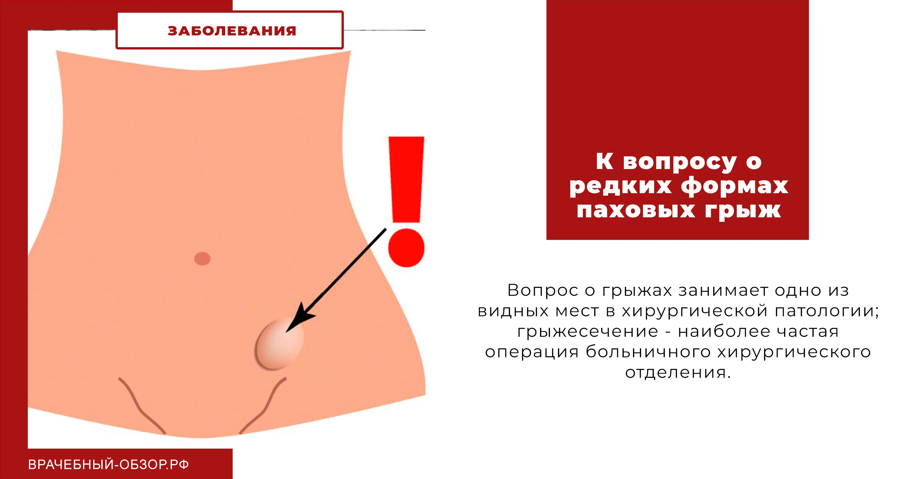 К вопросу о редких формах паховых грыж