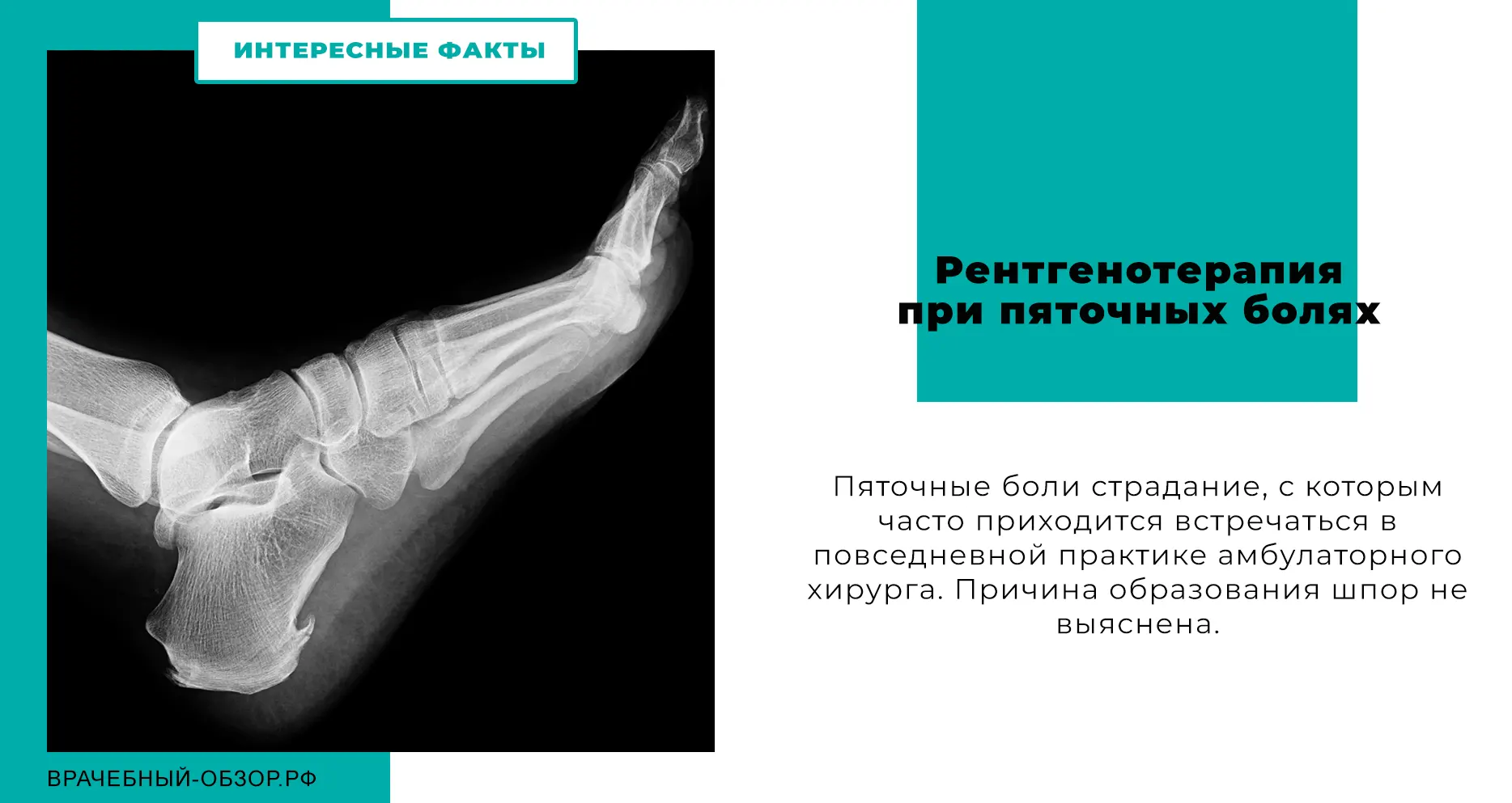 Рентгенотерапия при пяточных болях