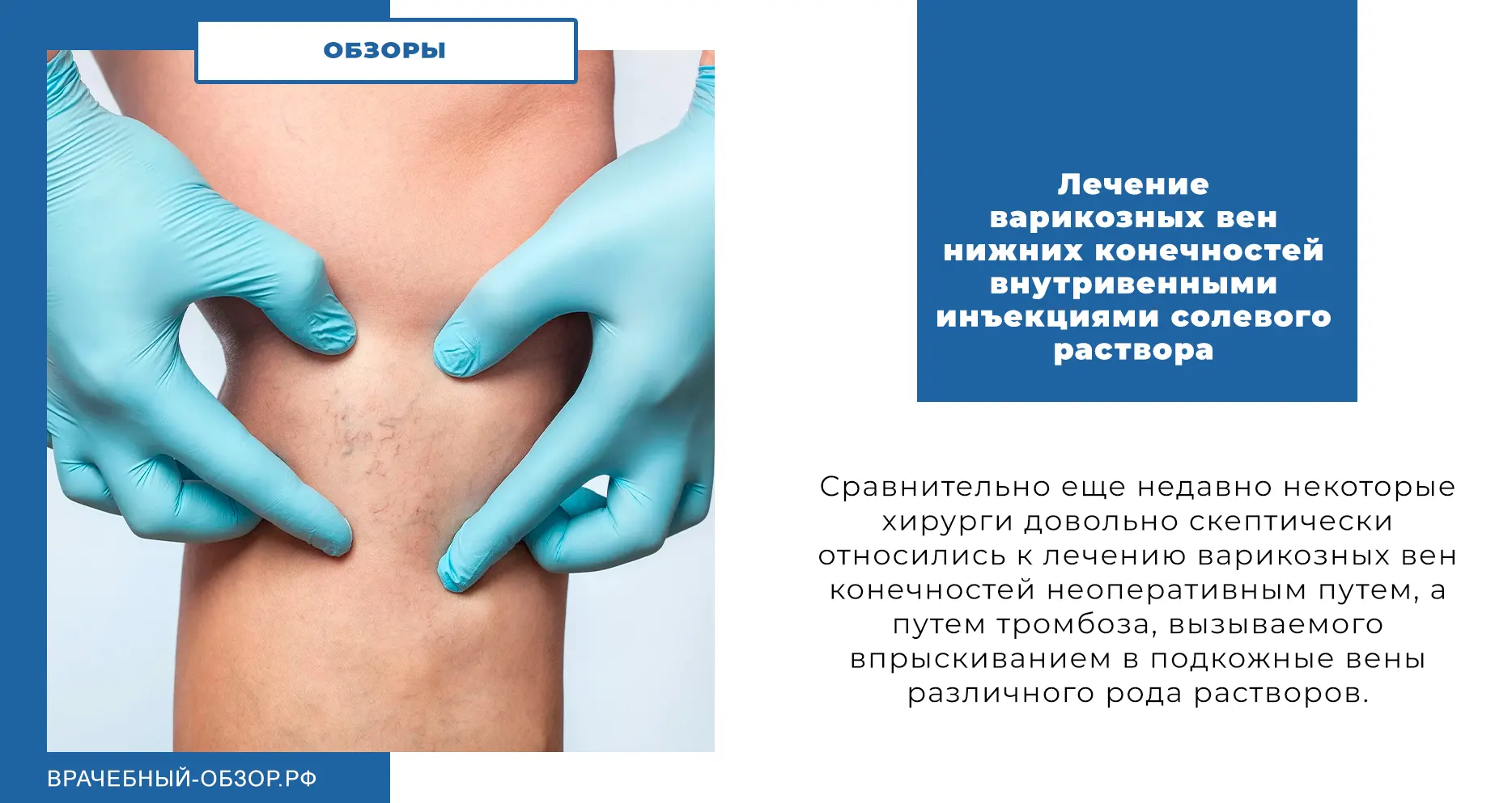 Лечение варикозных вен нижних конечностей внутривенными инъекциями солевого раствора