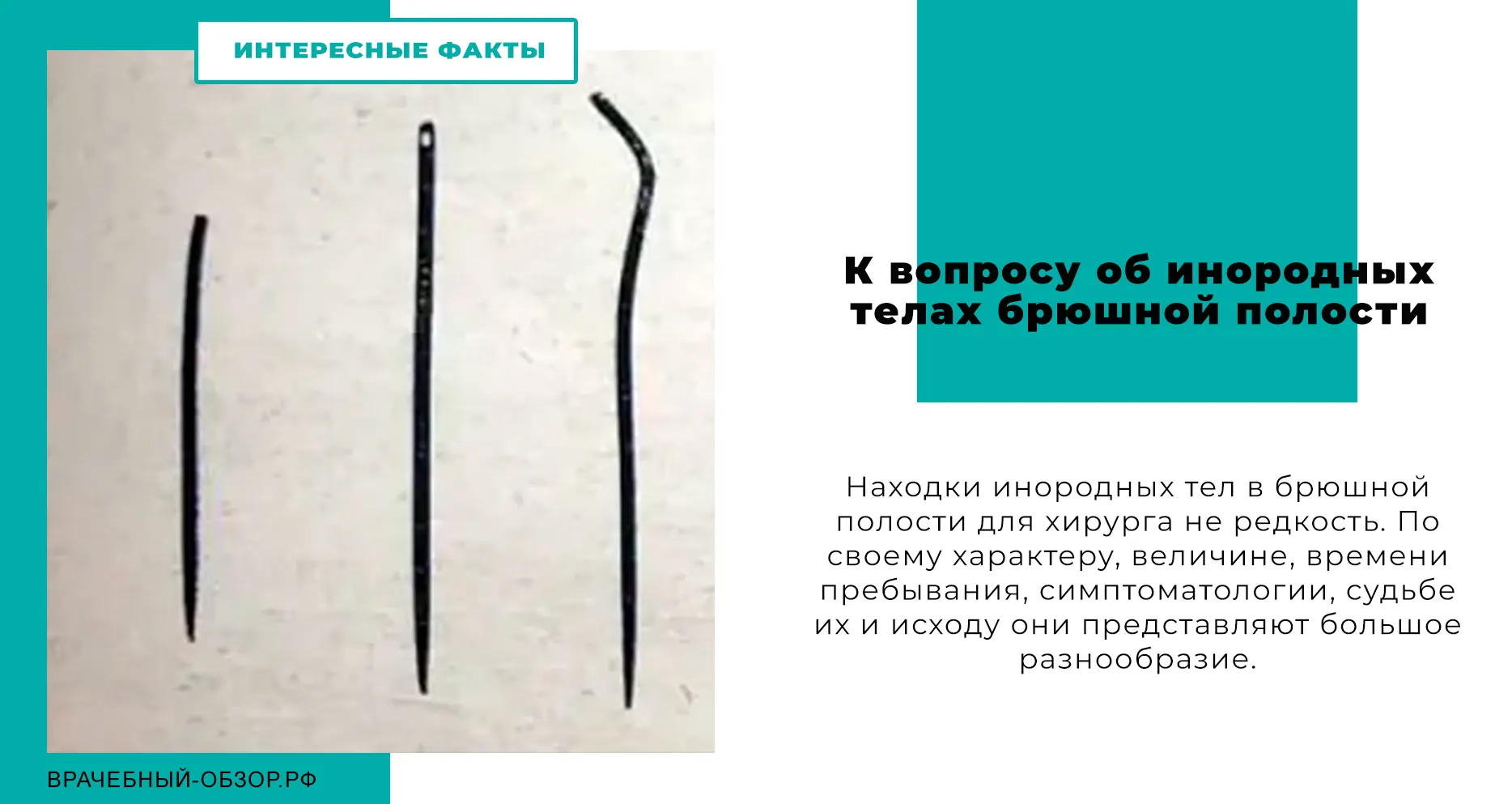 К вопросу об инородных телах брюшной полости