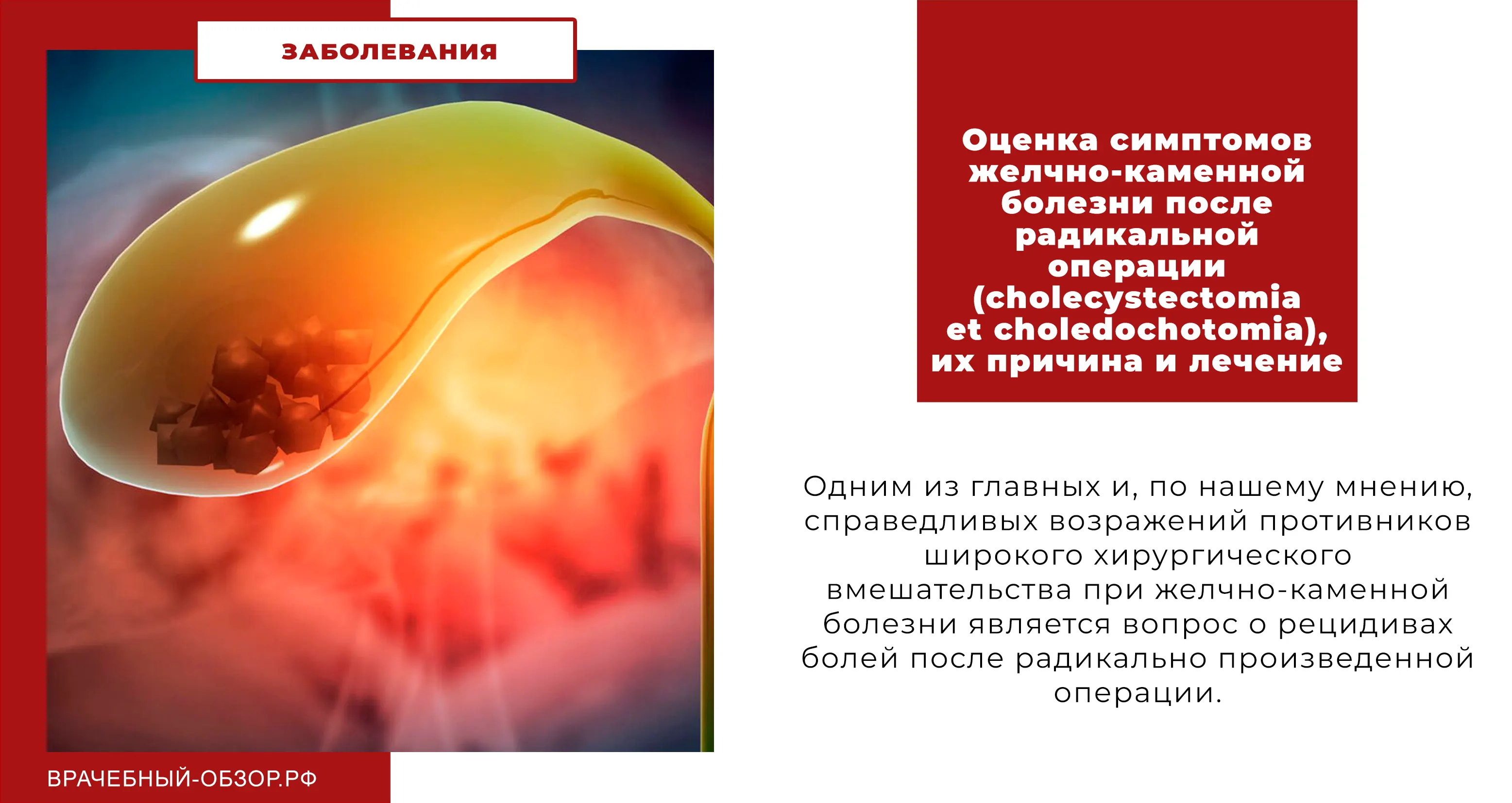 Оценка симптомов желчно-каменной болезни после радикальной операции (cholecystectomia et choledochotomia), их причина и лечение