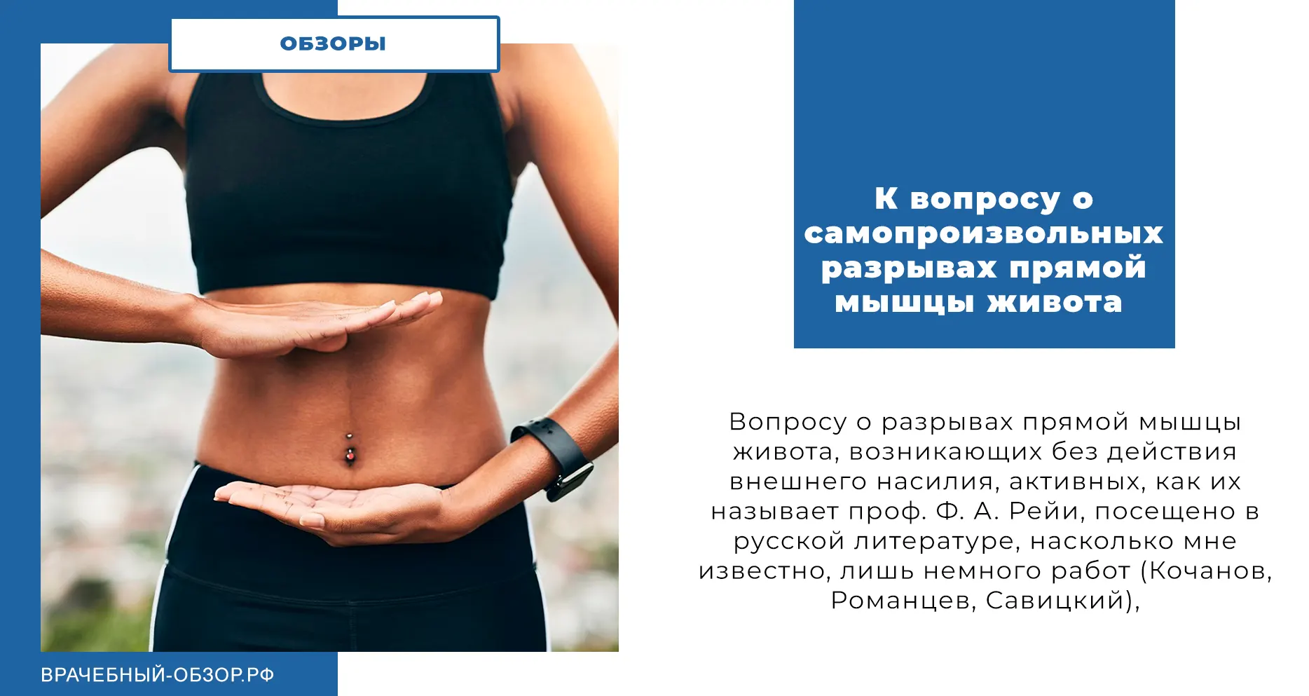 К вопросу о самопроизвольных разрывах прямой мышцы живота