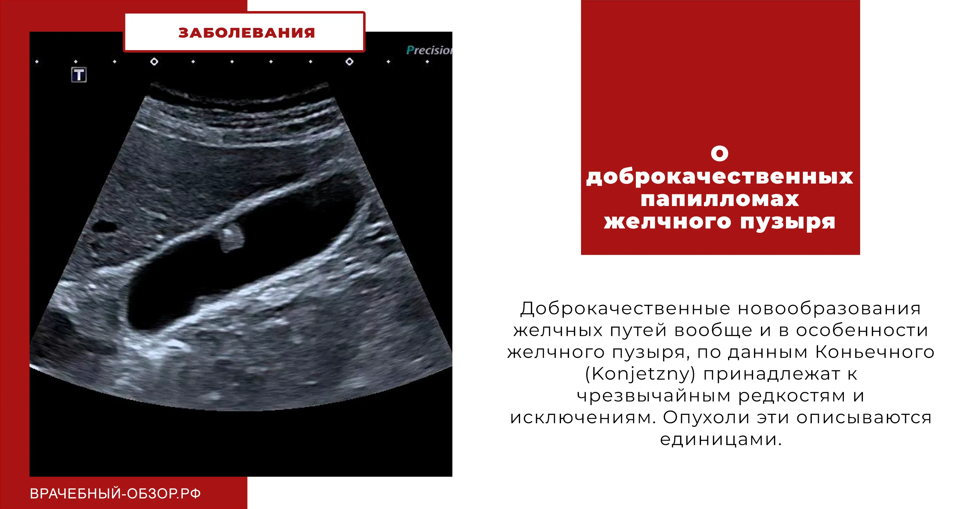 О доброкачественных папилломах желчного пузыря