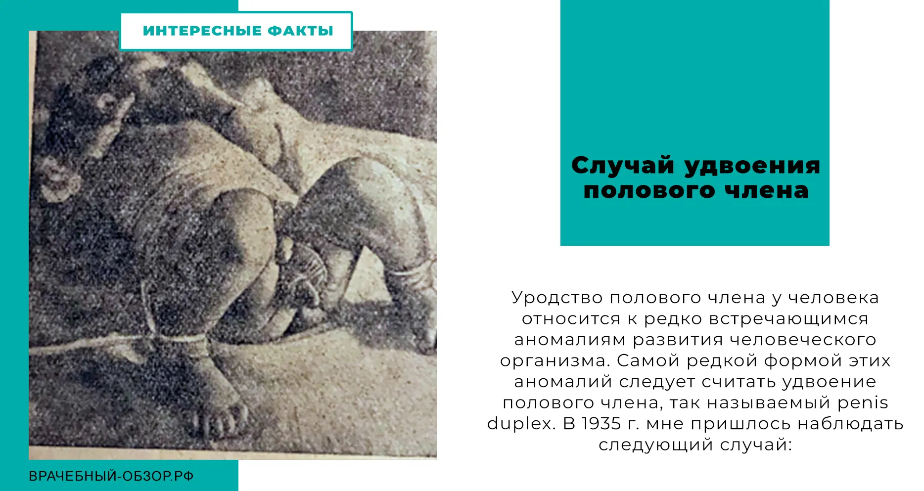 Случай удвоения полового члена