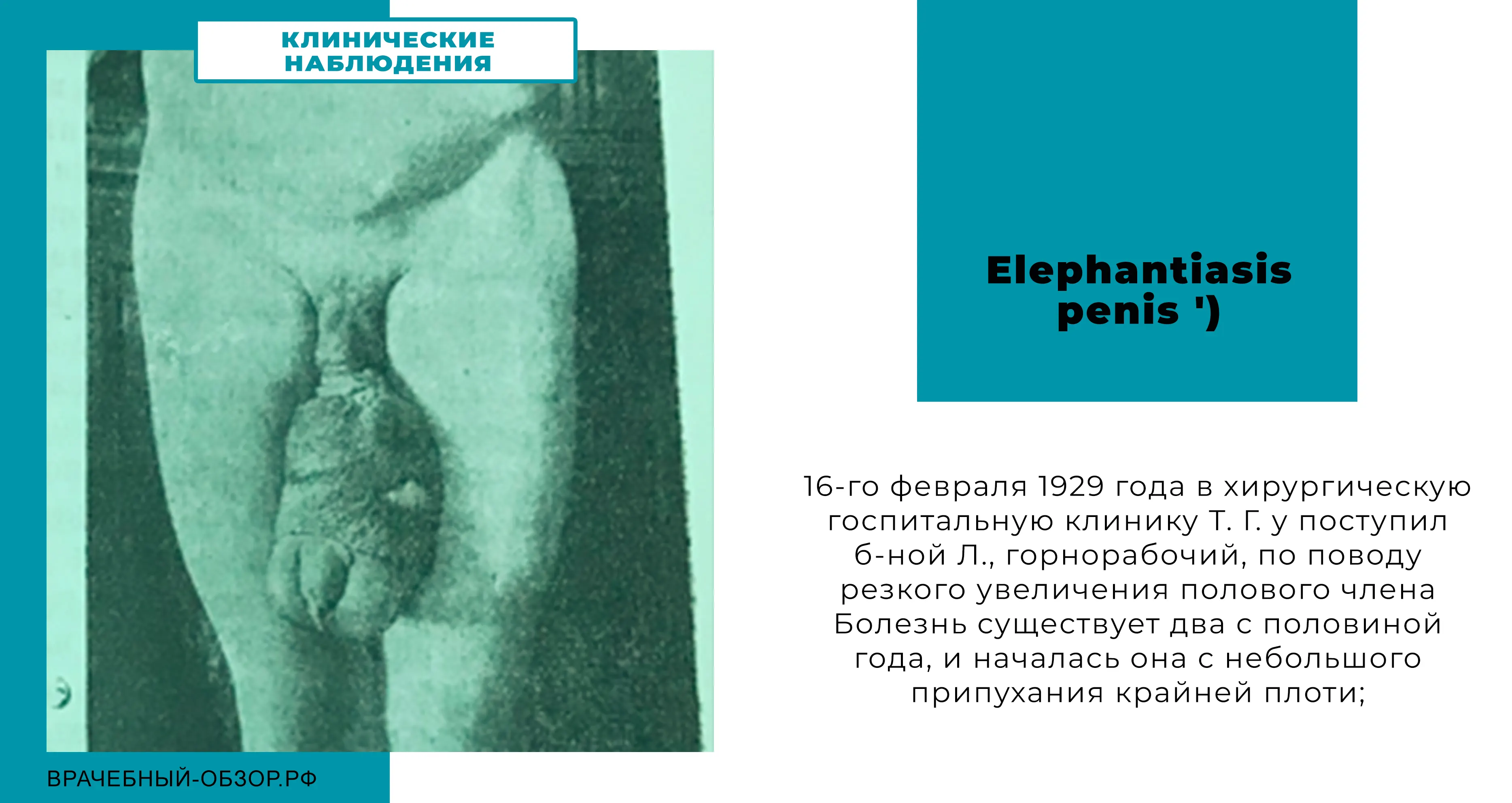 Elephantiasis penis ')