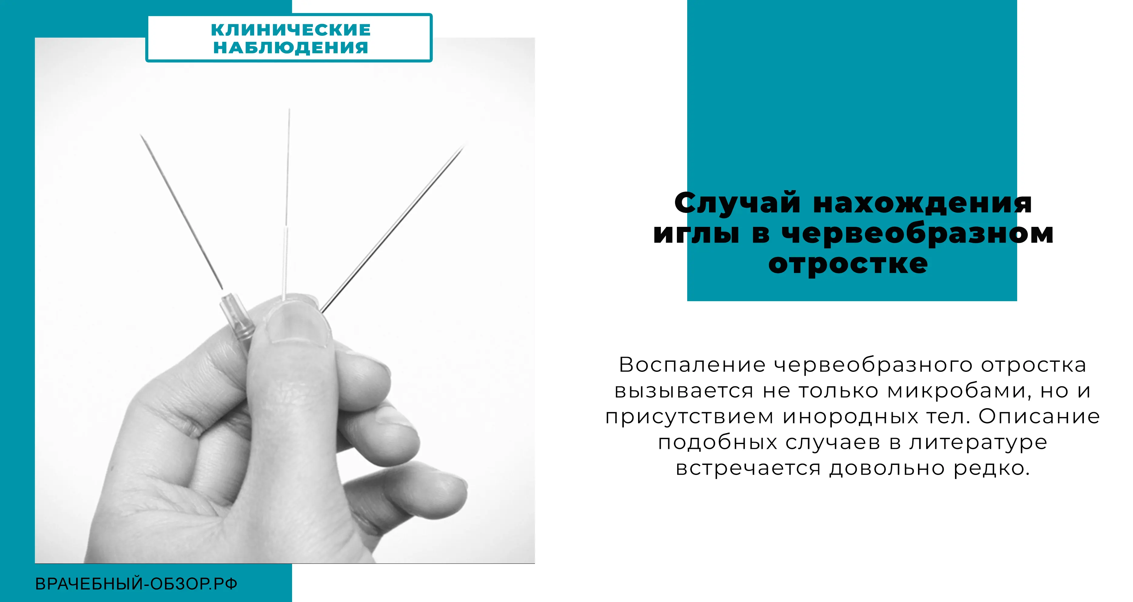 Случай нахождения иглы в червеобразном отростке
