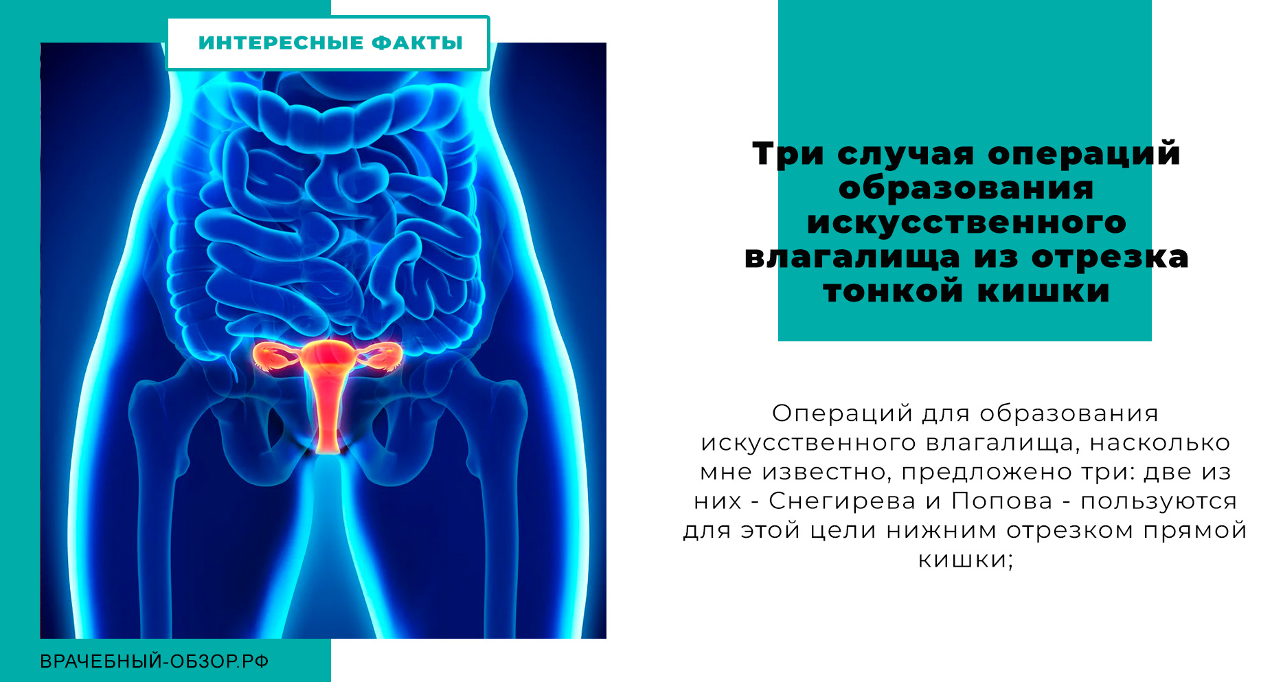 Три случая операций образования искусственного влагалища из отрезка тонкой кишки