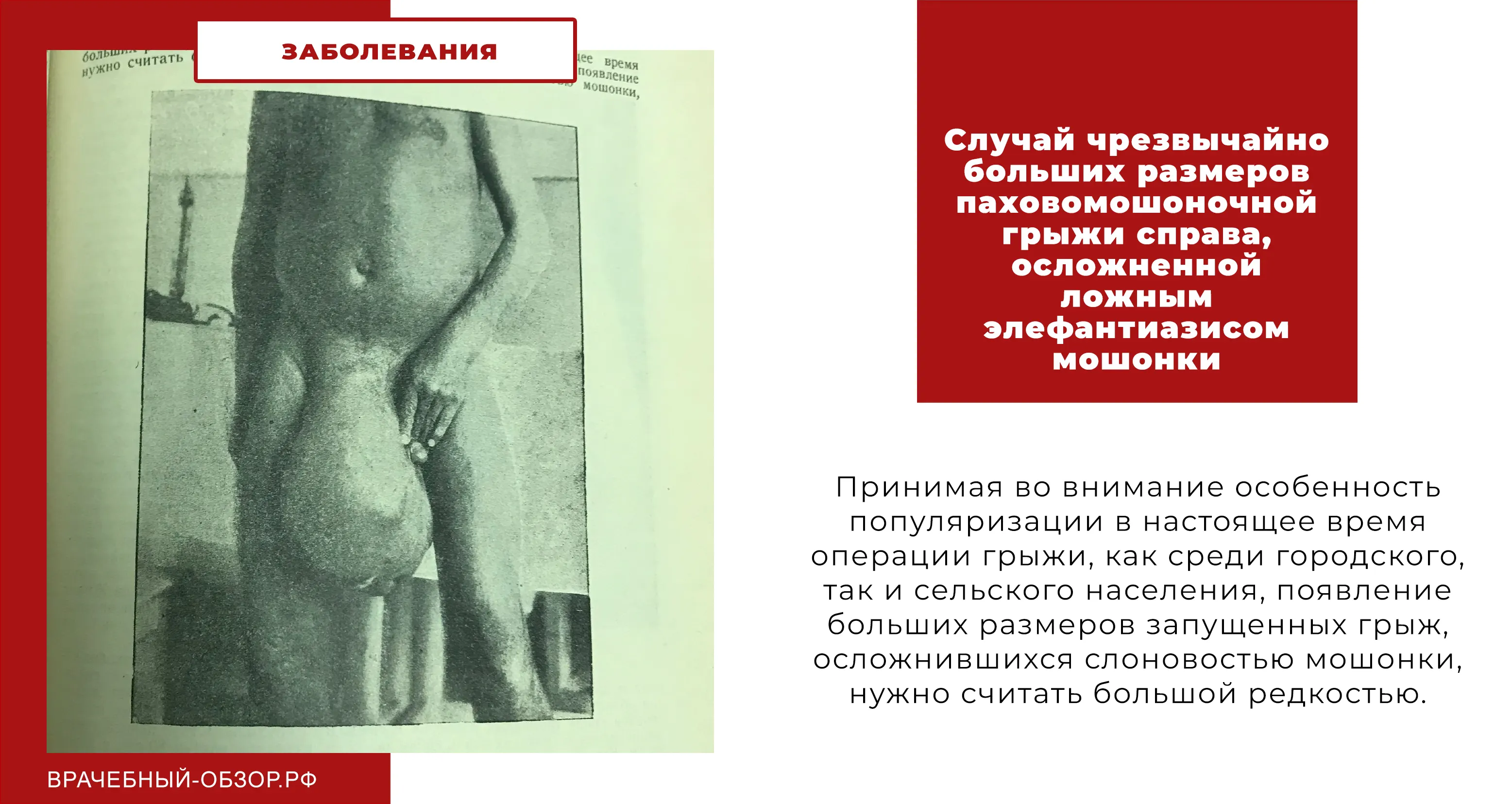 Случай чрезвычайно больших размеров паховомошоночной грыжи справа, осложненной ложным элефантиазисом мошонки