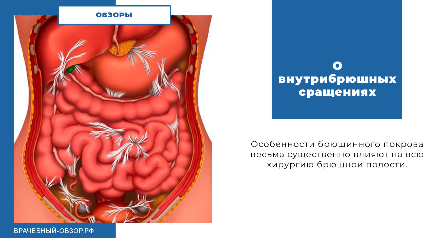 О внутрибрюшных сращениях