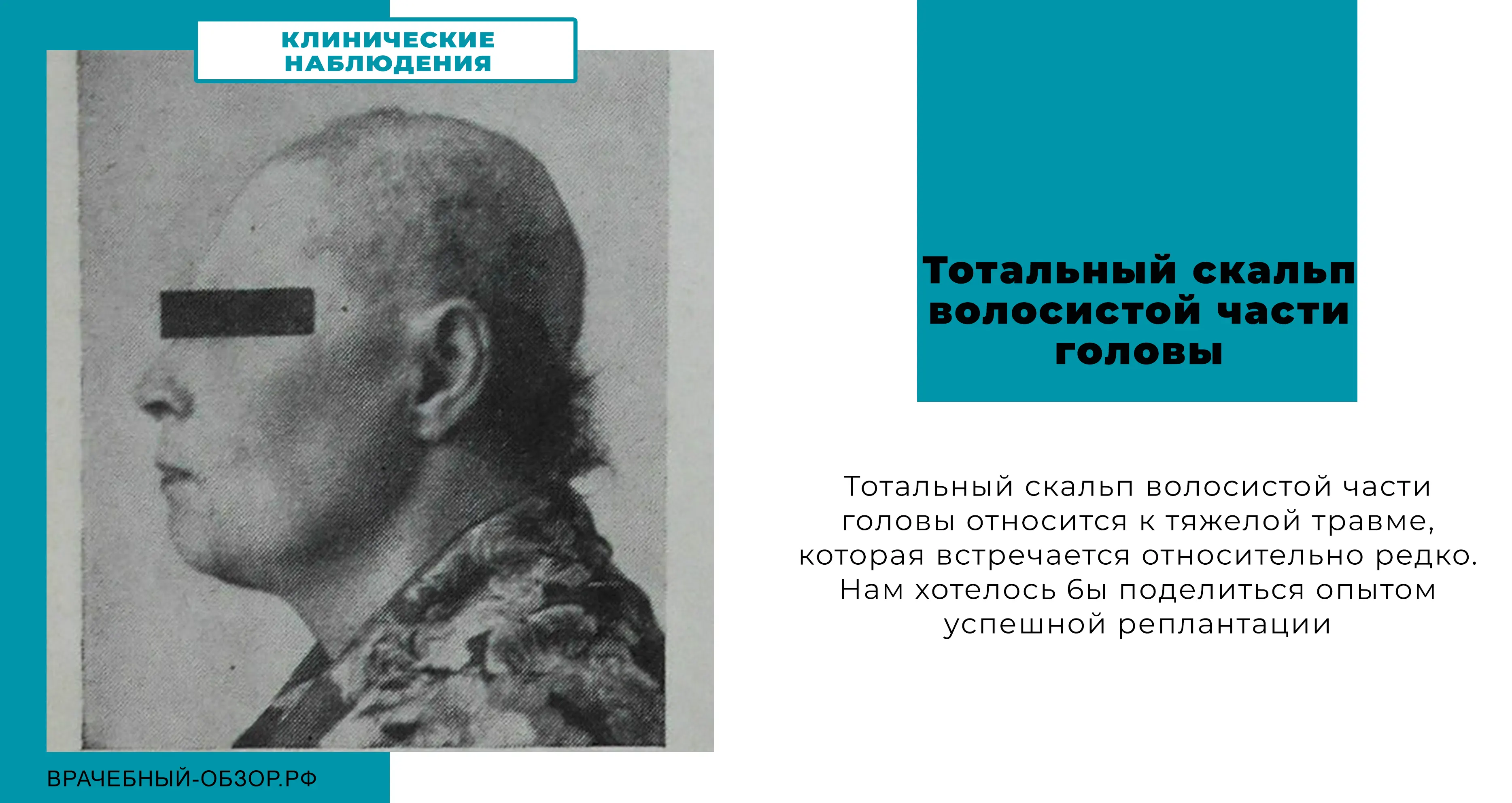 Тотальный скальп волосистой части головы