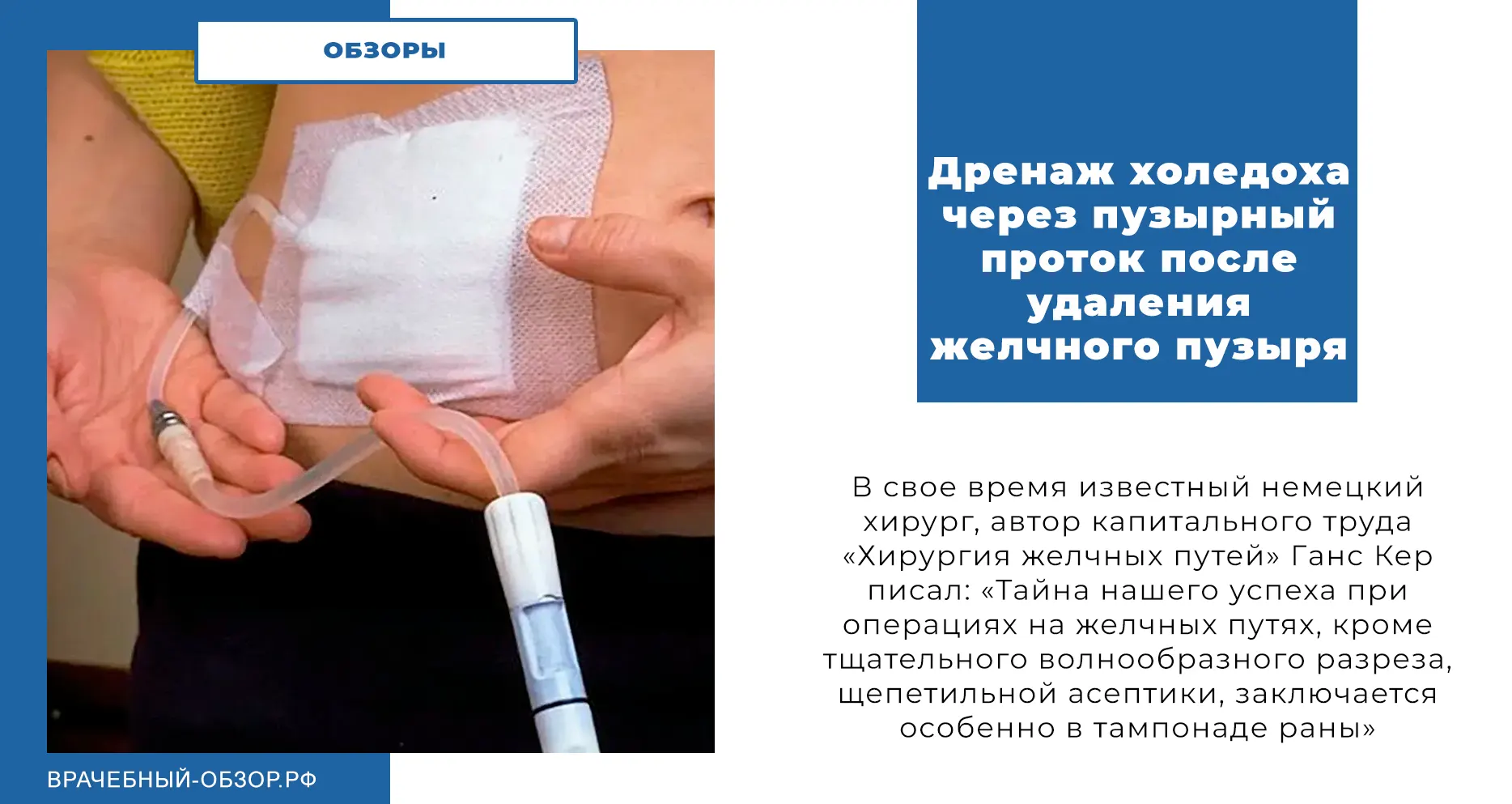 Дренаж холедоха через пузырный проток после удаления желчного пузыря
