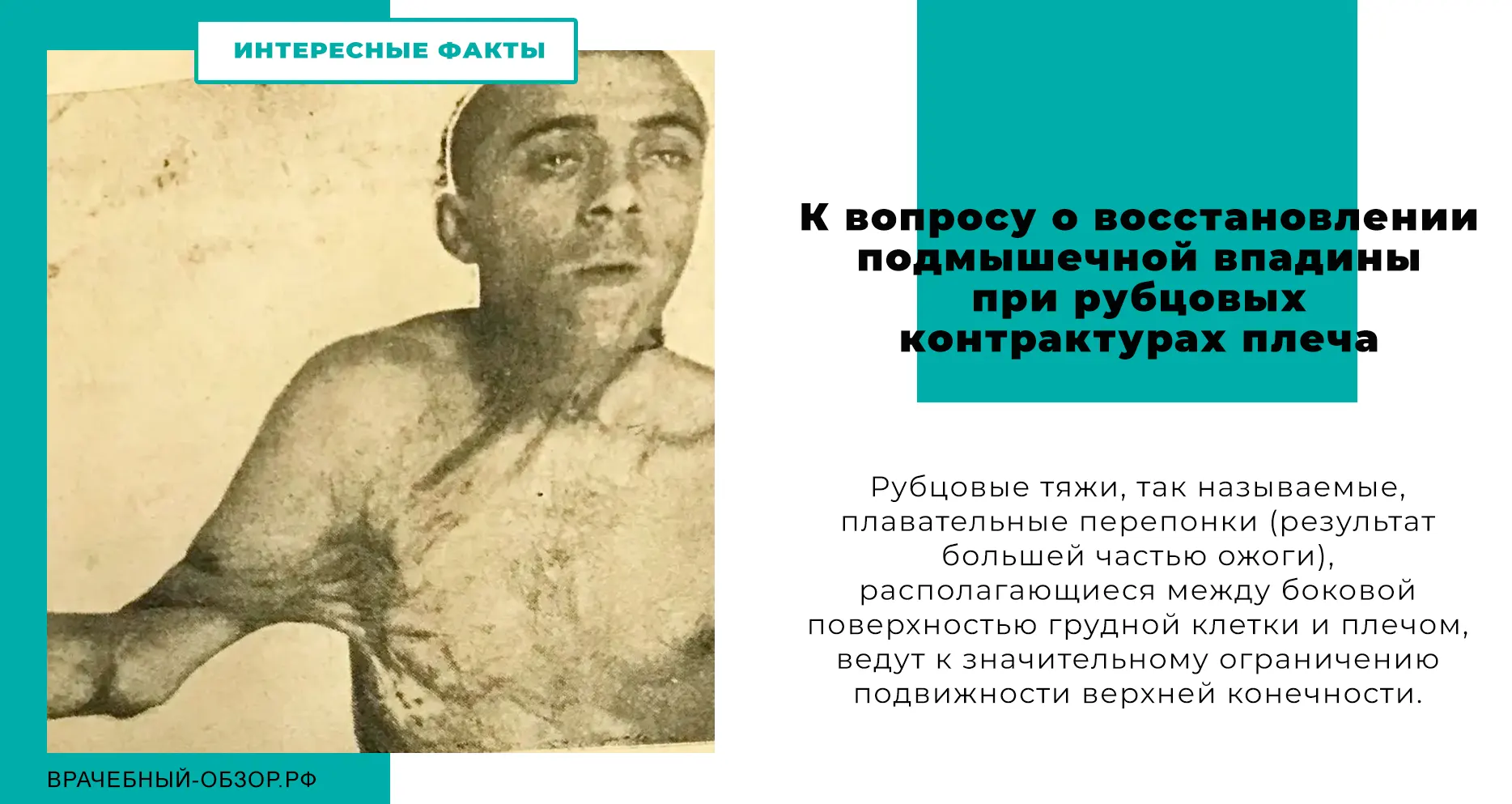 К вопросу о восстановлении подмышечной впадины при рубцовых контрактурах плеча
