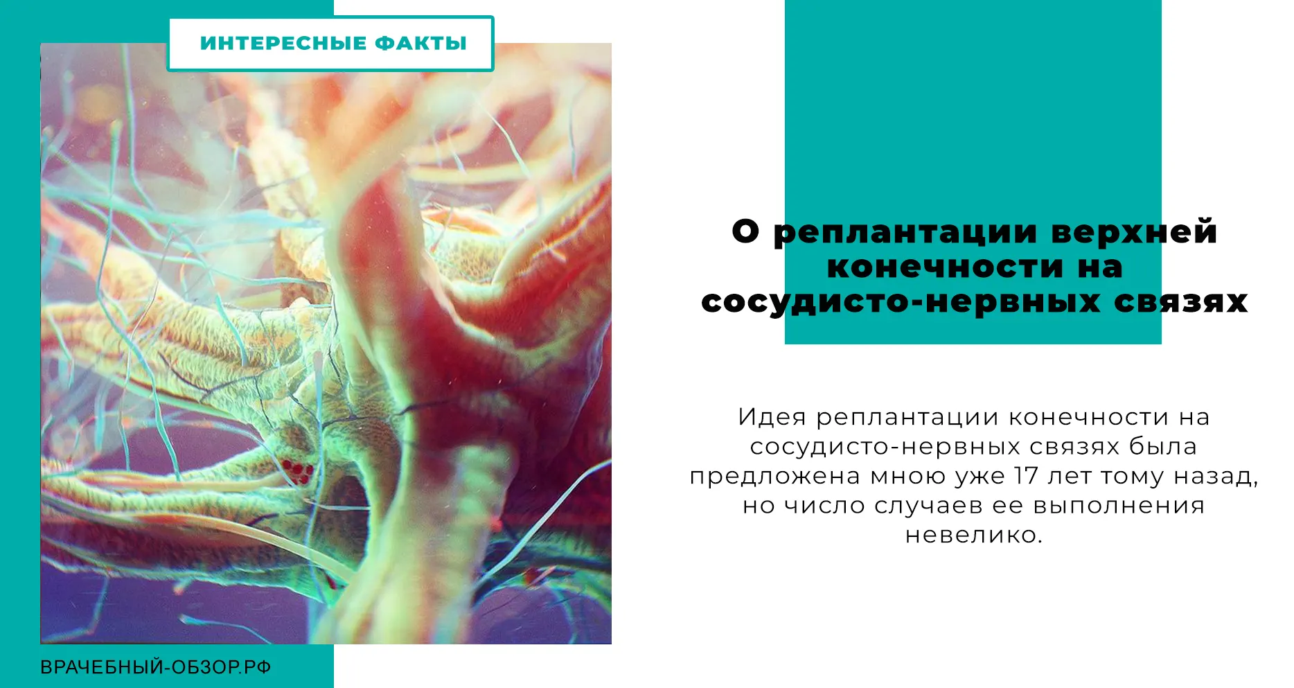 О реплантации верхней конечности на сосудисто-нервных связях