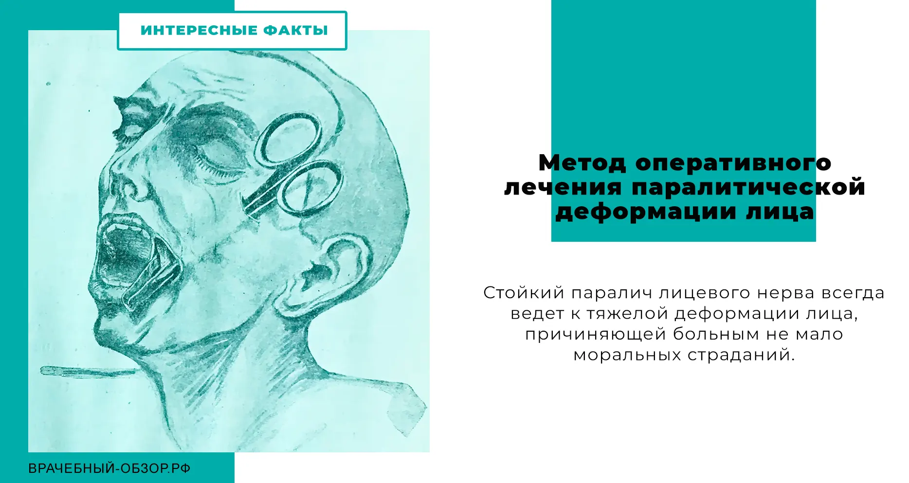 Метод оперативного лечения паралитической деформации лица