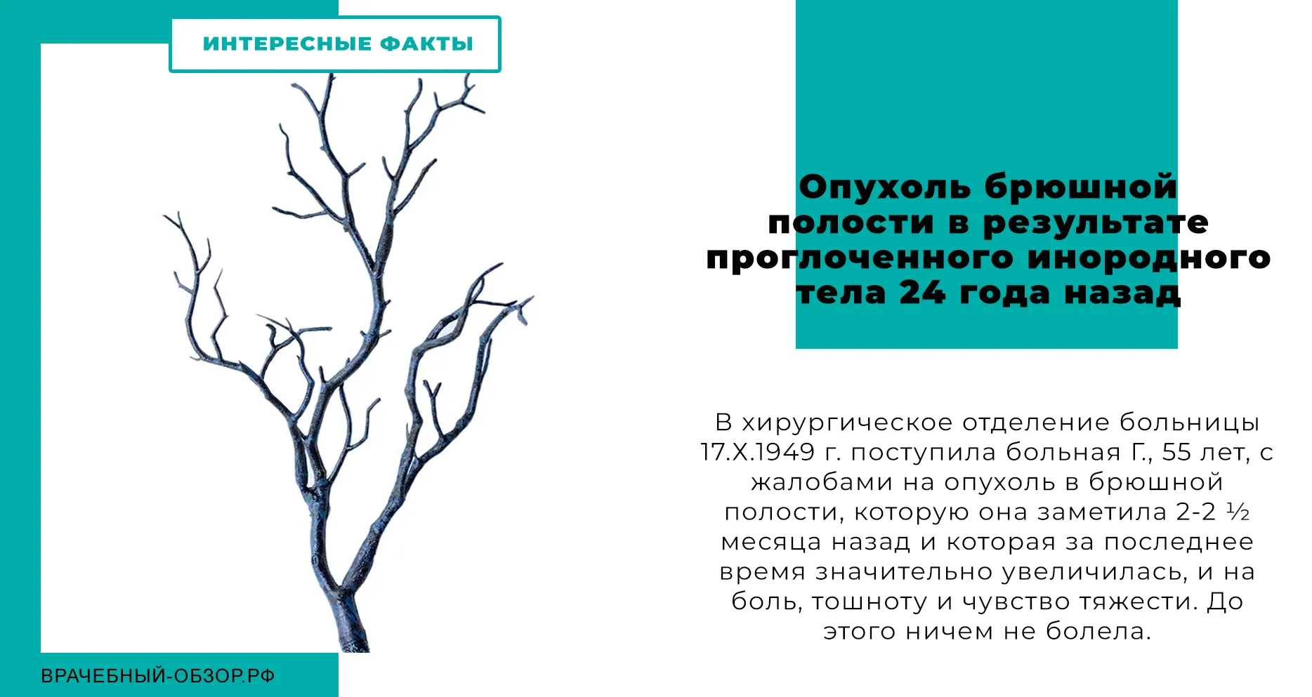 Опухоль брюшной полости в результате проглоченного инородного тела 24 года назад