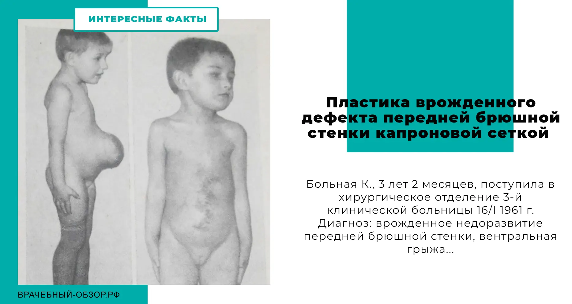 Пластика врожденного дефекта передней брюшной стенки капроновой сеткой
