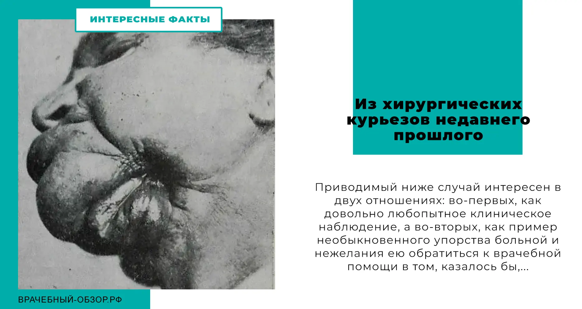 Из хирургических курьезов недавнего прошлого