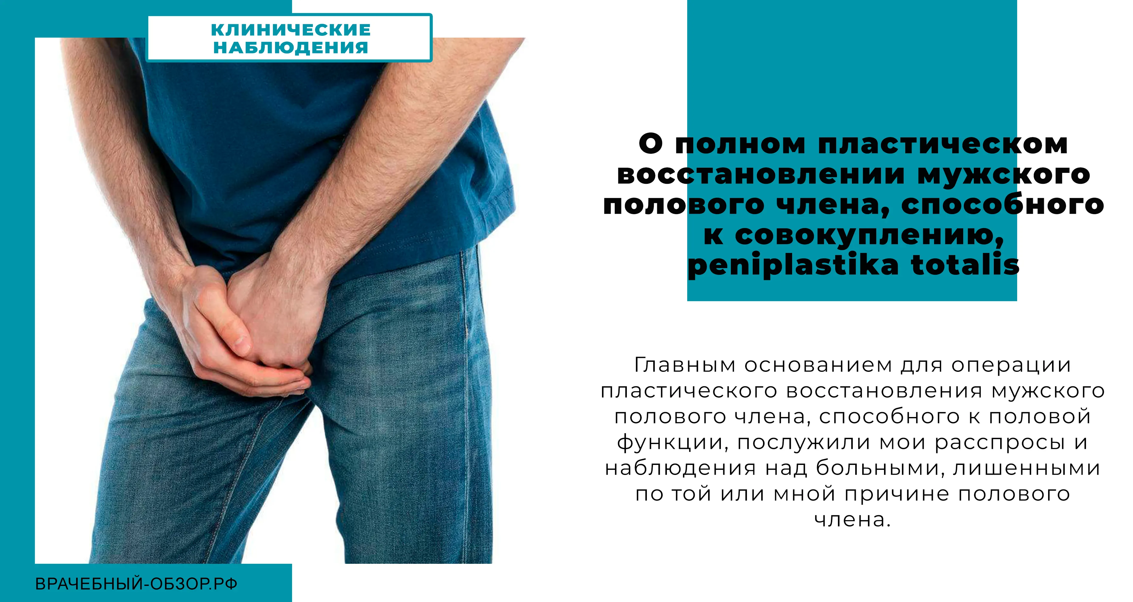 О полном пластическом восстановлении мужского полового члена, способного к совокуплению, peniplastika totalis