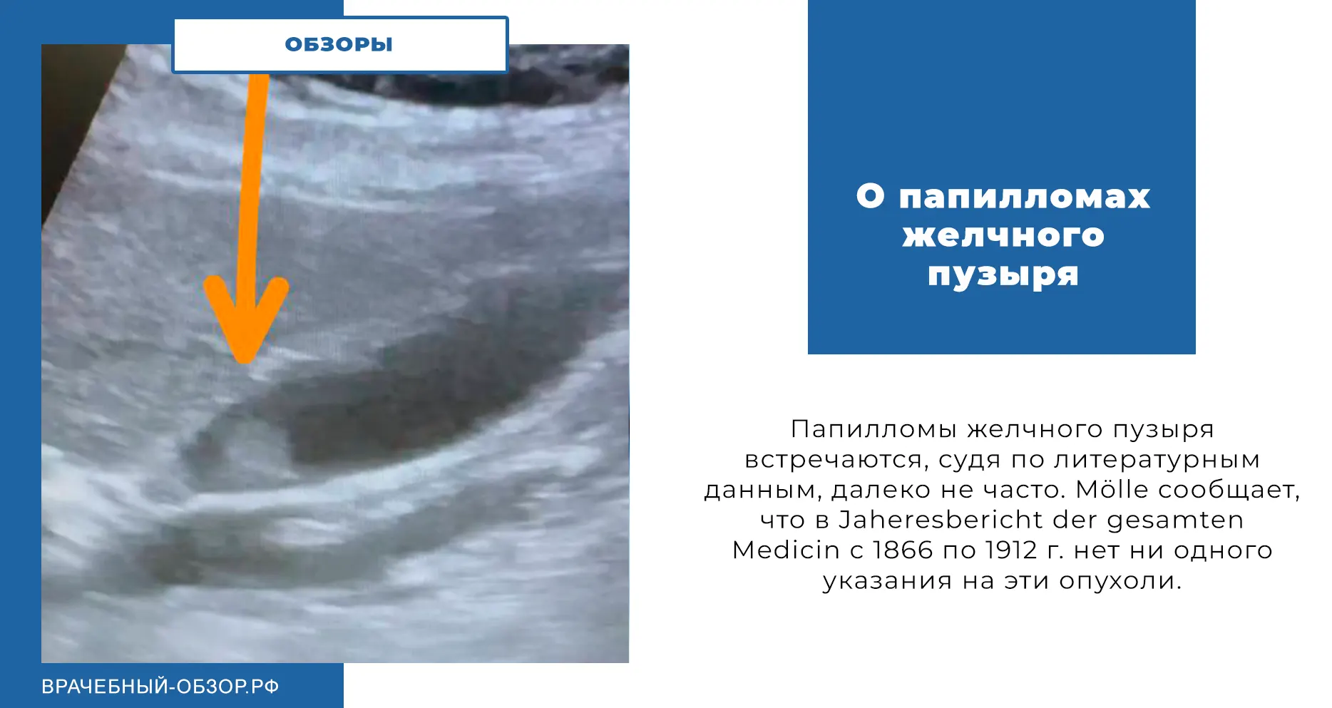 О папилломах желчного пузыря
