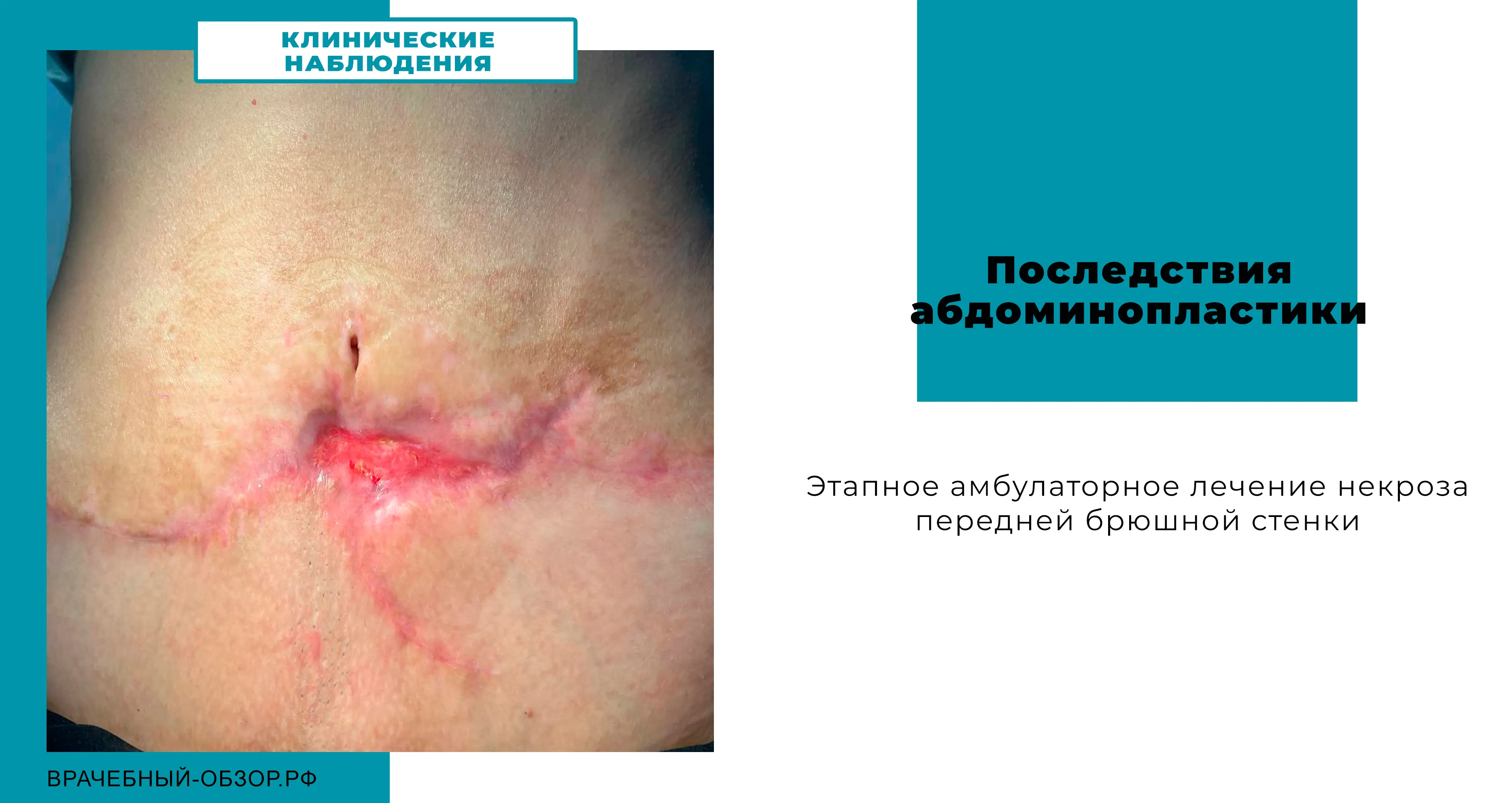 Последствия абдоминопластики