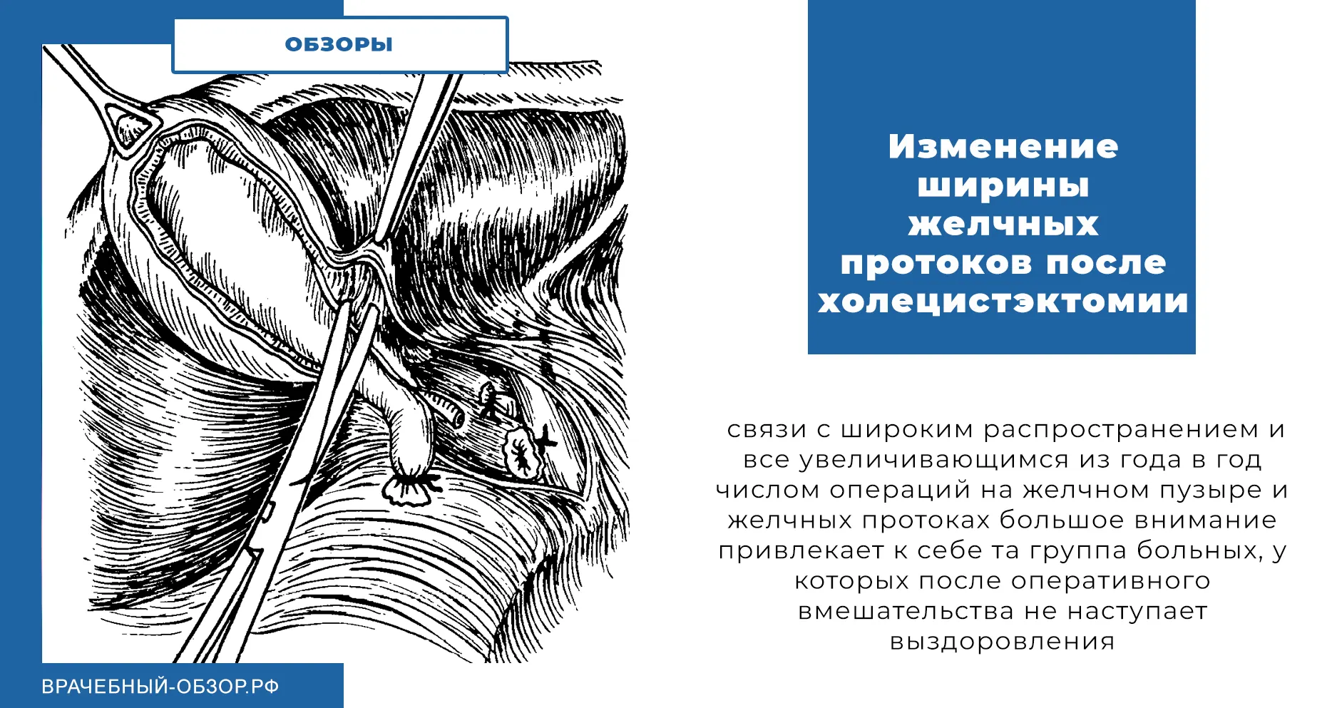 Изменение ширины желчных протоков после холецистэктомии