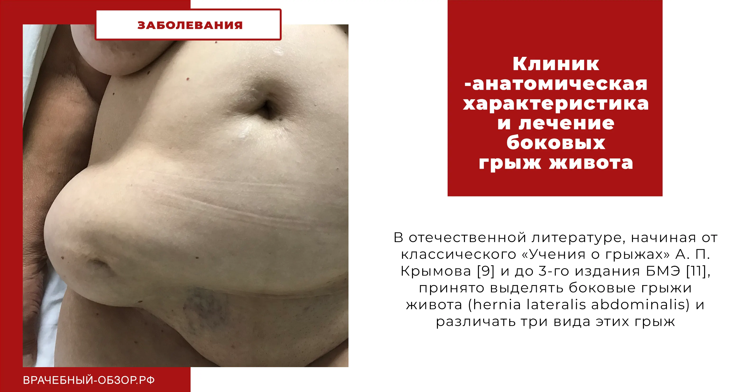 Клинико-анатомическая характеристика и лечение боковых грыж живота