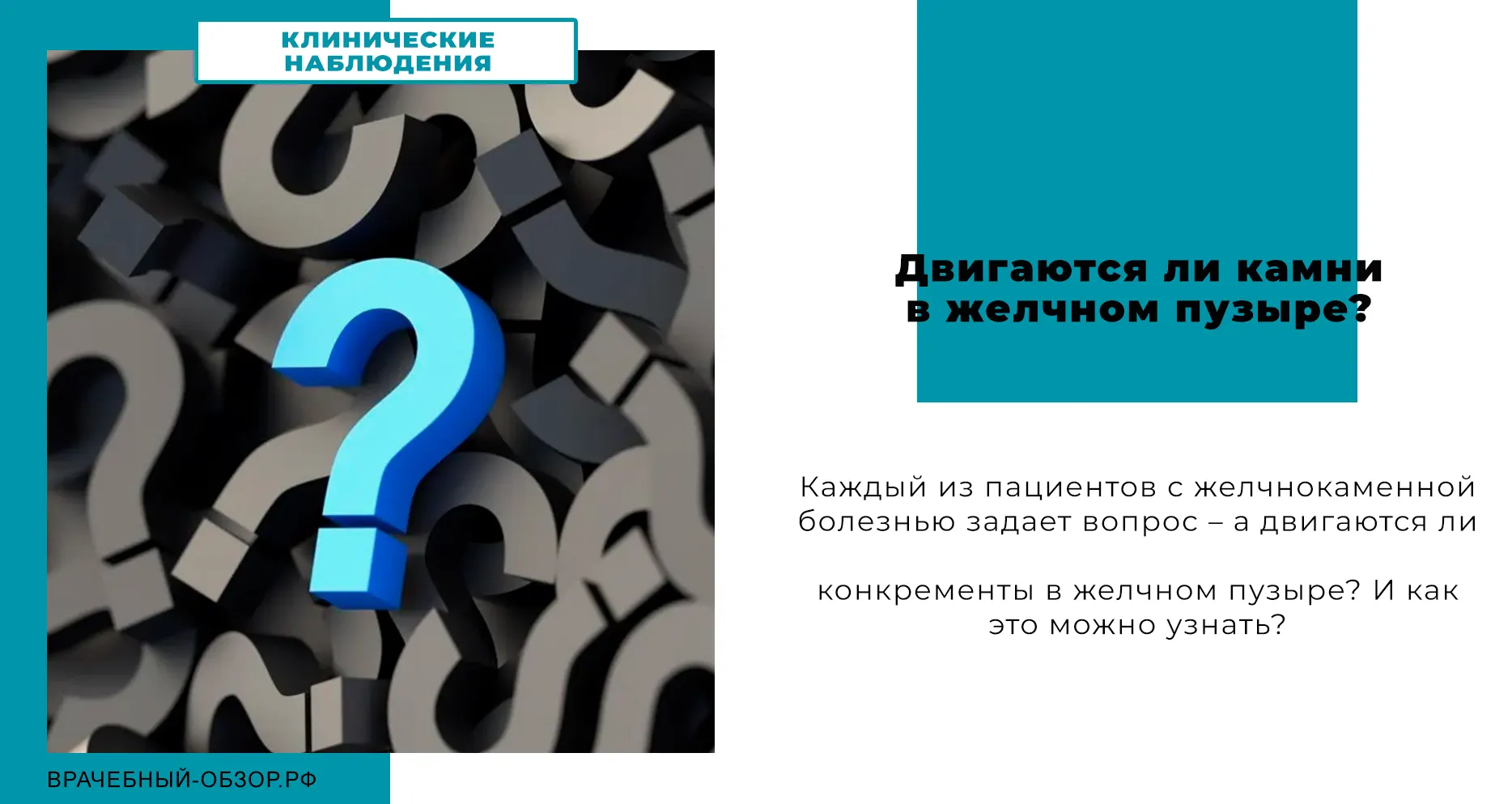 Двигаются ли камни в желчном пузыре?