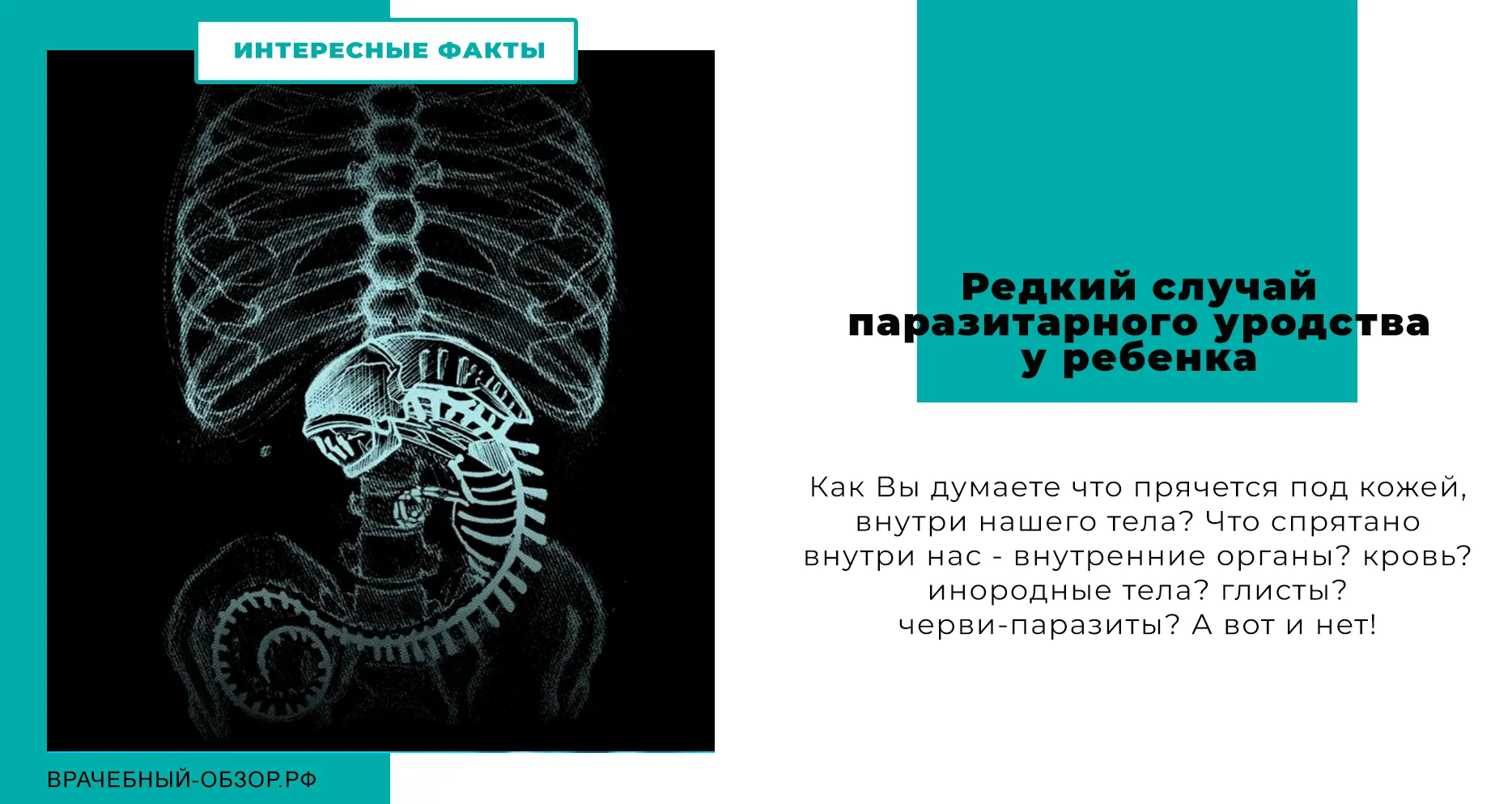 Редкий случай паразитарного уродства у ребенка
